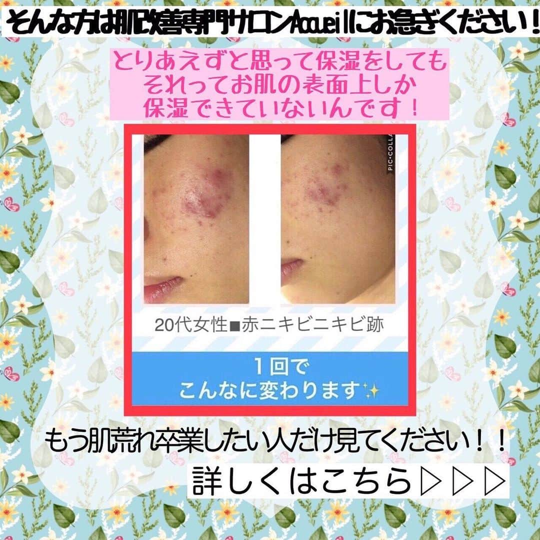 肌質改善専門サロン~Accueil~さんのインスタグラム写真 - (肌質改善専門サロン~Accueil~Instagram)「💙💚28日空きあり💛💜❤ * * 【ご予約はこちら👇🏼】 🌟🌟 @accueil_ikebukuro 🌟🌟 . ※今だけ期間限定クーポンあり . . . 肌荒れの原因は人それぞれなのにも関わらず、 周りの人と同じケアをしていませんか💦？？ * ❌お薬を塗っても飲んでも変わらない、、 ❌食事を気にしても肌が荒れる、、 ❌スキンケアを変えてもイマイチ、、 ❌何かしら常にトラブルが肌にある、、 ❌ニキビが繰り返しできる、、 * * そのお悩み解決できちゃいます😌✨ Accueilは、どのサロンに行っても良くならなかったお客さまたちや、 どの皮膚科に行っても変化がなかったお客さまたちが多く訪れてくださっています🙌💕* * * * もう悩まない！！！ 繰り返さないところまでしっかりと根本改善していきます☺️ そろそろ肌荒れから卒業しませんか？ * →→→初回体験はこちらから👉🏼 @accueil_ikebukuro * * * * Accueilでのお手当は、、 * 機械は一切使いません🙅‍♀️❌ 使うお化粧品は １００％天然の「ミネルヴァ化粧品」🌲🍃 ニキビの炎症がある方・アトピーの方でも 安心して受けていただける事ができる お肌にとても優しいエステです♡♡ * * お肌のお悩みなら、何でもお任せください😊💕 * * ■「インスタ見ました！」 で、 初回体験￥26,000 →→✨￥５，９８０✨ * * * --------当サロンのご予約方法≫--------- *  1️⃣当サロンのインスタTopのURL ⭐『Hotpepper Beauty』の 「instagram限定クーポン」にてご予約可能♡♡ * * 2️⃣インスタのDMからご予約 （下記項目を記載の上、お問い合わせください♪） * 🔶お名前（フルネーム） * 🔶お電話番号 * 🔶希望日時（第１～第３希望） * 🔶ご希望のメニュー * * 3️⃣お電話でのご予約✨ 　03-6912-5705にお願いします♡ ----------------------------------------- * * @accueil_ikebukuro ✨ #ニキビ #ニキビ跡 #毛穴 #乾燥肌 #ニキビ跡ケア #肌荒れ #ニキビ跡改善 #ニキビ肌改善 #ニキビ治療 #保湿 #毛穴の黒ずみ #毛穴の開き #スキンケア #毛穴吸引 #アトピー女子 #ニキビ皮膚科  #美肌ケア  #ニキビ専門 #肌質改善 #背中ニキビ #アトピー肌 #乾燥 #ニキビケア #毛穴ケア #アトピー治療 #肌悩み #スキンケア難民 #肌トラブル改善 #スキンケア大事 #目指せ美肌」5月28日 22時19分 - accueil_ikebukuro