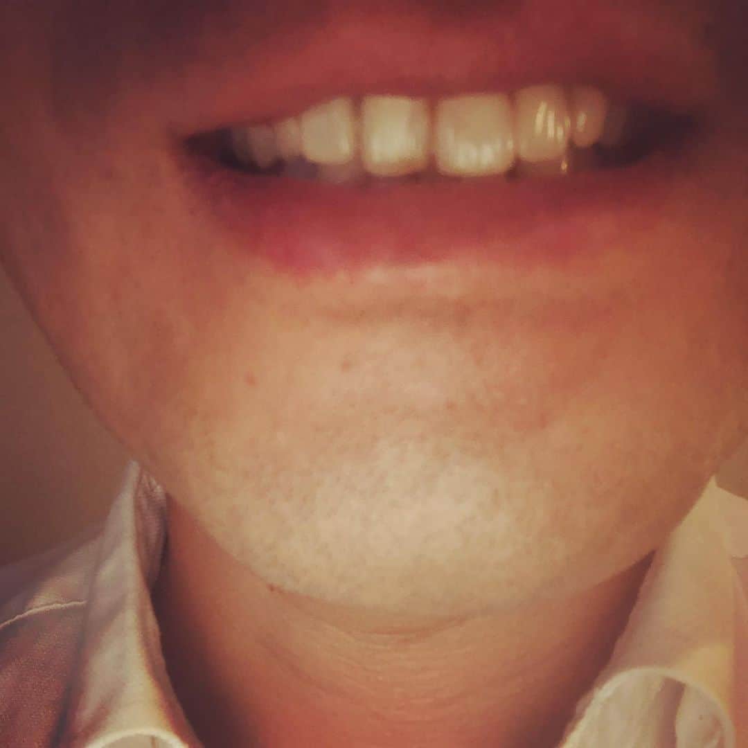 武智正剛さんのインスタグラム写真 - (武智正剛Instagram)「復活！！！ #今日仮歯が取れましたが #バイク川崎バイクが知り合いの歯医者を紹介してくれて #復活しました #バキっと折れた仮歯を #簡単に治してくれて #ビックリした #BKBヒィーヤ！！ #バイク川崎バイクそしてお医者様ありがとうございました #スーパーマラドーナ武智」5月29日 21時03分 - supamaradonatake