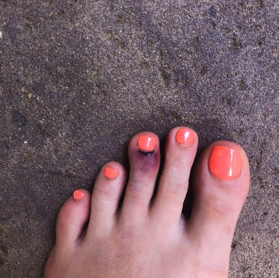 Halseyさんのインスタグラム写真 - (HalseyInstagram)「I was trying to save a hurt butterfly in the jungle. I broke my toe. turns out the butterfly was already dead. I have alien feet I know. I sacrificed having nice feet when I committed to a life of dancing on stages and saving dead butterflies. this hurts. 3 radio shows in California this week. Catch me hobbling around!」5月30日 4時59分 - iamhalsey