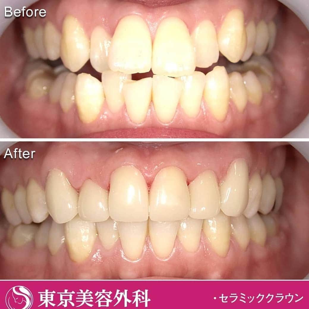 東京美容外科公式さんのインスタグラム写真 - (東京美容外科公式Instagram)「明日6/2（日）赤坂院審美歯科ご予約まだ間に合います😁 ㅤㅤㅤㅤㅤㅤㅤㅤㅤㅤㅤ 東京美容外科の1Dayセラミックのご案内です🙇‍♀️ ㅤㅤㅤㅤㅤㅤㅤㅤㅤㅤㅤ 通常、歯科技工士が作成する被せ物や詰め物を、東京美容外科では3D CADシステムを使い、歯科医師みずから歯の設計をし、噛み合わせを考えて患者様一人ひとりにあったオーダメイドな歯をご提供しております🧐 ㅤㅤㅤㅤㅤㅤㅤㅤㅤㅤㅤ ✨短期間で虫歯の治療と白い歯にしたい。 ✨歯科治療にあまり時間をかけたくない。 ✨歯並びを治したい。 等々... ㅤㅤㅤㅤㅤㅤㅤㅤㅤㅤㅤ 軽度の虫歯治療とセラミックの詰め物でしたら、最短1時間で治療が終了いたします👍 詳しくはプロフィールのURLから1Dayセラミックの詳細をご覧ください👀 ㅤㅤㅤㅤㅤㅤㅤㅤㅤㅤㅤ ※当院では保険診療は行っておりません。 ㅤㅤㅤㅤㅤㅤㅤㅤㅤㅤㅤ ご契約の方は🚖ワンメータータクシー代ご負担いたしますので、領収書は必ずお持ちください！ ㅤㅤㅤㅤㅤㅤㅤㅤㅤㅤㅤ 土日祝日も診察受付中！ 予約の状況にもよりますが、当日予約も可能です。 ㅤㅤㅤㅤㅤㅤㅤㅤㅤㅤㅤ ==🎁お問い合わせはこちら🎁==== 詳しくはプロフィールのURLから公式サイトへ♪ ▼フリーダイヤル 0120-545-871 （コールセンター受付時間：9：00～21：00） ▼LINE予約 @ tkc_shinbi ========================= ㅤㅤㅤㅤㅤㅤㅤㅤㅤㅤㅤ #東京美容外科 #赤坂 #PMTC #歯石除去 #スケーリング #審美 #ホワイトニング #美容整形 #きれい #整形 #美活 #美容外科 #プチ審美歯科 #インビザライン #アンチエイジング #歯科 #美容整形外科 #ジルコニア #全身麻酔 #小顔 #ノンスクラプデンチャー #ヒアルロン酸 #セレック #CEREC #白い歯 #痛くない治療 #セラミック #矯正 #親知らず」6月1日 17時07分 - tokyobiyougeka_jimukyoku
