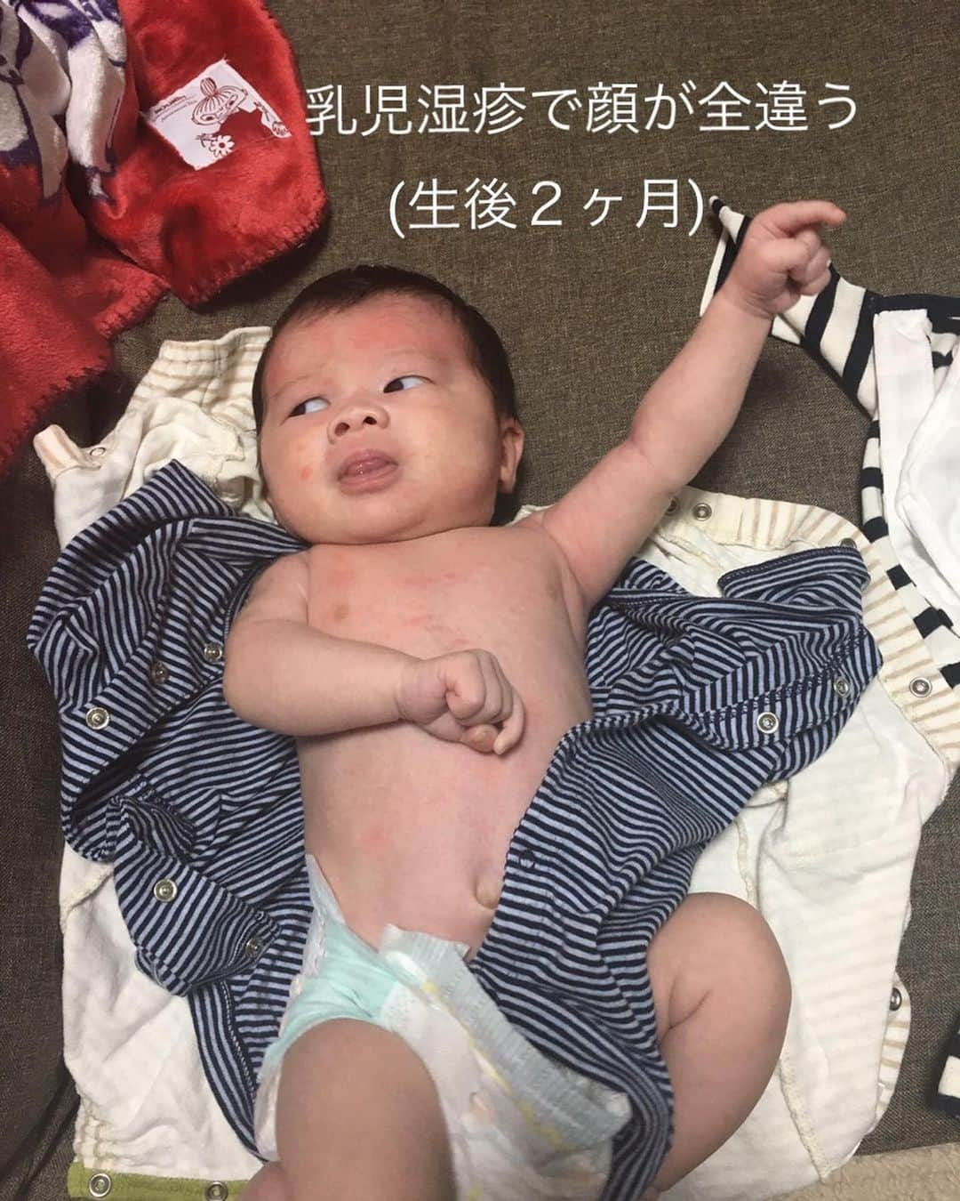 ゆみみさんのインスタグラム写真 - (ゆみみInstagram)「気をてらったバンドマンみたい。乳児湿疹が始まった頃 (生後２ヶ月)  #子育て日記 #育児 #育児日記 #子育てぐらむ #1歳3ヶ月 #息子 #令和元年 #ママ #ママリ #おやばか部#ママスタ #コドモノ #コドモ #ママタス #生後2ヶ月」6月4日 13時15分 - yumimi76