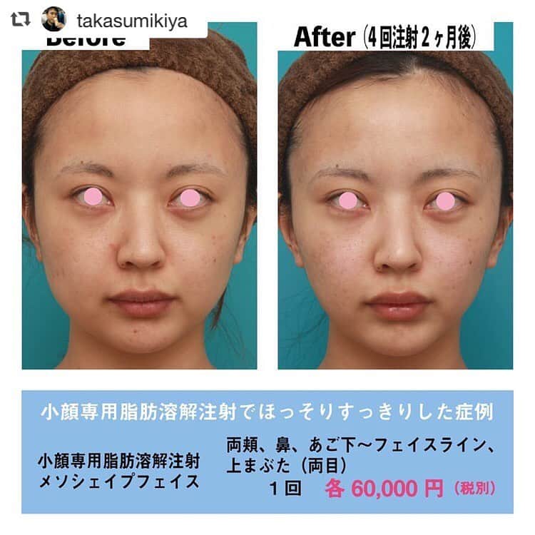 高須クリニック名古屋院さんのインスタグラム写真 - (高須クリニック名古屋院Instagram)「#repost @takasumikiya via @PhotoAroundApp  小顔専用脂肪溶解注射メソシェイプフェイスでほっそりすっきりした症例 ・ 20代女性の患者様で、顔の贅肉をとって小顔になりたいというご要望でした。 診察させていただいたところ、骨格的には、元々顔が大きいほうではなく、むしろ、平均よりやや小さいくらいでした。 ・ エラ、頬骨、顎先（オトガイ）の骨が特別突出していることもないため、骨切り手術の適応もありませんでした。 頬からフェイスライン～顎にかけて、少し余分な皮下脂肪があり、顔がたるんでいたので、小顔専用脂肪溶解注射メソシェイプフェイスで余分な脂肪を除去することになりました。 ・ 4回注射後には、余分な皮下脂肪がほどよくなくなり、すっきりした小顔になりました。 また、たるんでいた部分の皮下脂肪が減量されたため、たるみが改善し、より小顔になりました。 ・ 小顔専用脂肪溶解注射メソシェイプフェイスを頬や顎下のたるんでいる部分に注射し、たるみのボリュームを減量すると、たるみを改善させ、リフトアップと同じような効果があります。 ただし、その場合は、皮膚のたるみに皮下脂肪がたくさんついている人が適応になります。 ただ単に皮膚がたるんでいるだけで、余分な皮下脂肪がない人は、小顔専用脂肪溶解注射メソシェイプフェイスの適応はありません。 ・ 【料金】 ●小顔専用脂肪溶解注射メソシェイプフェイス 両頬1回：60,000円（税別）／あご先：60,000円（税別）／あご下〜フェイスライン1回：60,000円（税別）／まぶた（両目）1回：60,000円（税別）／鼻1回：60,000円（税別） ※料金は2019年4月22日現在 ※保険適用外、自由診療 ・ 【リスク・副作用など】 ●内出血（注射針が血管に当たってしまった場合） ●アレルギー症状（パイナップルアレルギーの方） ・ 【ご予約・お問い合わせ】 名古屋院☎︎ 052-564-1187 名古屋院📱 @takasuclinic_nagoya ↑名古屋院インスタのプロフィール画面からも直接コンタクトが取れます📲 https://www.takasu.co.jp/ ・ ・ #高須クリニック #高須クリニック名古屋院 #高須幹弥 #高須英津子 #美容整形 #整形 #二重 #埋没法 #二重切開 #ヒアルロン酸 #鼻 #ニキビ #ダイエット #たるみ #眼瞼下垂 #シワ #ほうれい線 #整形したい #美容好きな人と繋がりたい #可愛くなりたい #綺麗になりたい #平行二重 #末広二重 #プチ整形 #二重整形 #目尻切開 #目頭切開 #ビフォーアフター」6月5日 13時09分 - takasuclinic_nagoya