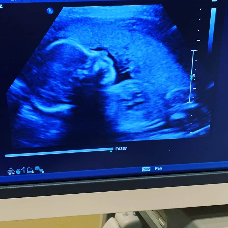 ニック・カーターさんのインスタグラム写真 - (ニック・カーターInstagram)「All I can say is that I’m SO EXCITED!  #baby #ultrasound #happyfather #happiness #peace #fathertobe #fatherhood #family #growingfamily #happiness #babies」6月22日 7時15分 - nickcarter