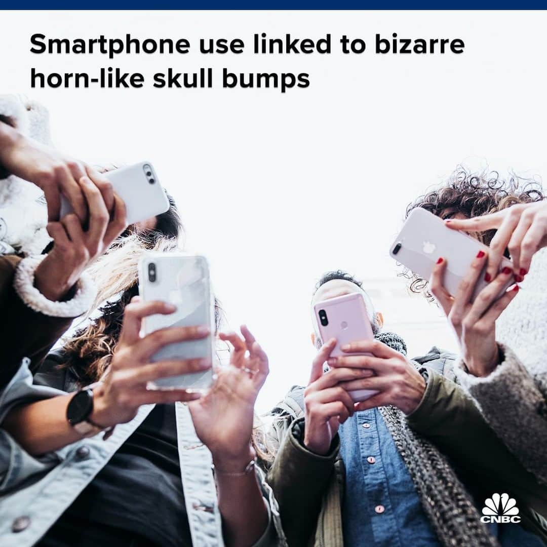 CNBCさんのインスタグラム写真 - (CNBCInstagram)「It sounds like something out of a science fiction plot — are people really growing horn-like structures on their skulls due to smartphone use?﻿ ﻿ A study published last year in the journal Scientific Reports found bony growths called bone spurs on the bases of people's skulls that could be linked to looking down at a cell phone. Younger people were found to have larger growths.﻿ ﻿ Bone spurs — small bony growths that can form on the edges of bones — often form from repetitive motions. One type of repetitive motion is tilting the head forward, perhaps to look at a smartphone. ﻿ ﻿ To read more, visit the link in bio.﻿ *﻿ *﻿ *﻿ *﻿ *﻿ *﻿ *﻿ *﻿ #smartphone #technology #tech #iphone #health #medicine #wellness #medical #nurse #doctor #physician #care #insurance #medicare #healthcare #healthnews #news #cnbc #business #businessnews」6月22日 9時00分 - cnbc