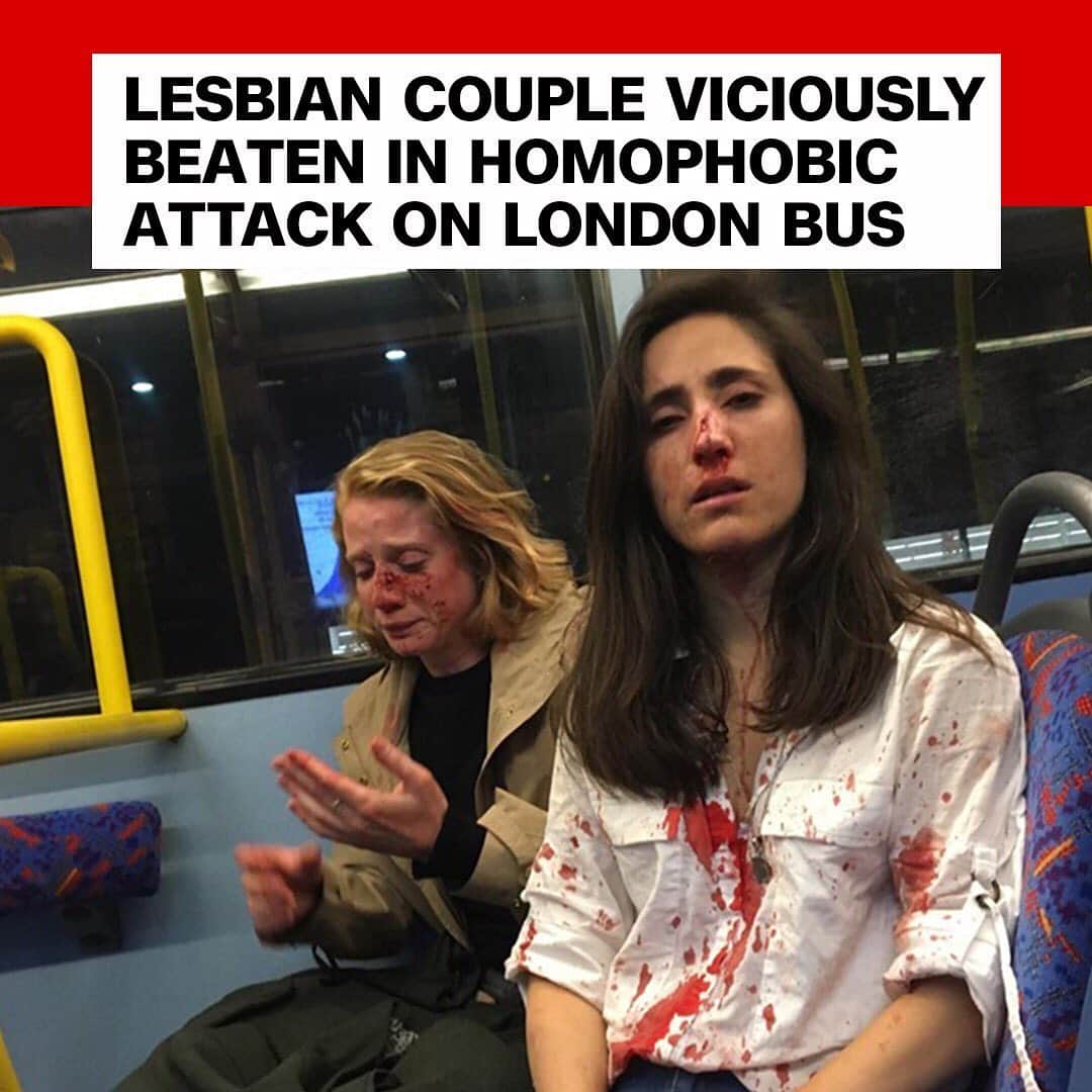 CNNさんのインスタグラム写真 - (CNNInstagram)「Two women say they were beaten and robbed by a group of men in a homophobic attack on a London bus. One of the women, Melania Geymonat, posted this photo on Facebook of herself and her girlfriend covered in blood, along with her account of the assault. "They started behaving like hooligans, demanding that we kissed so they could enjoy watching..." she said in the post. London police said they are investigating the attack. (📸: Melania Geymonat/Facebook)」6月7日 23時35分 - cnn
