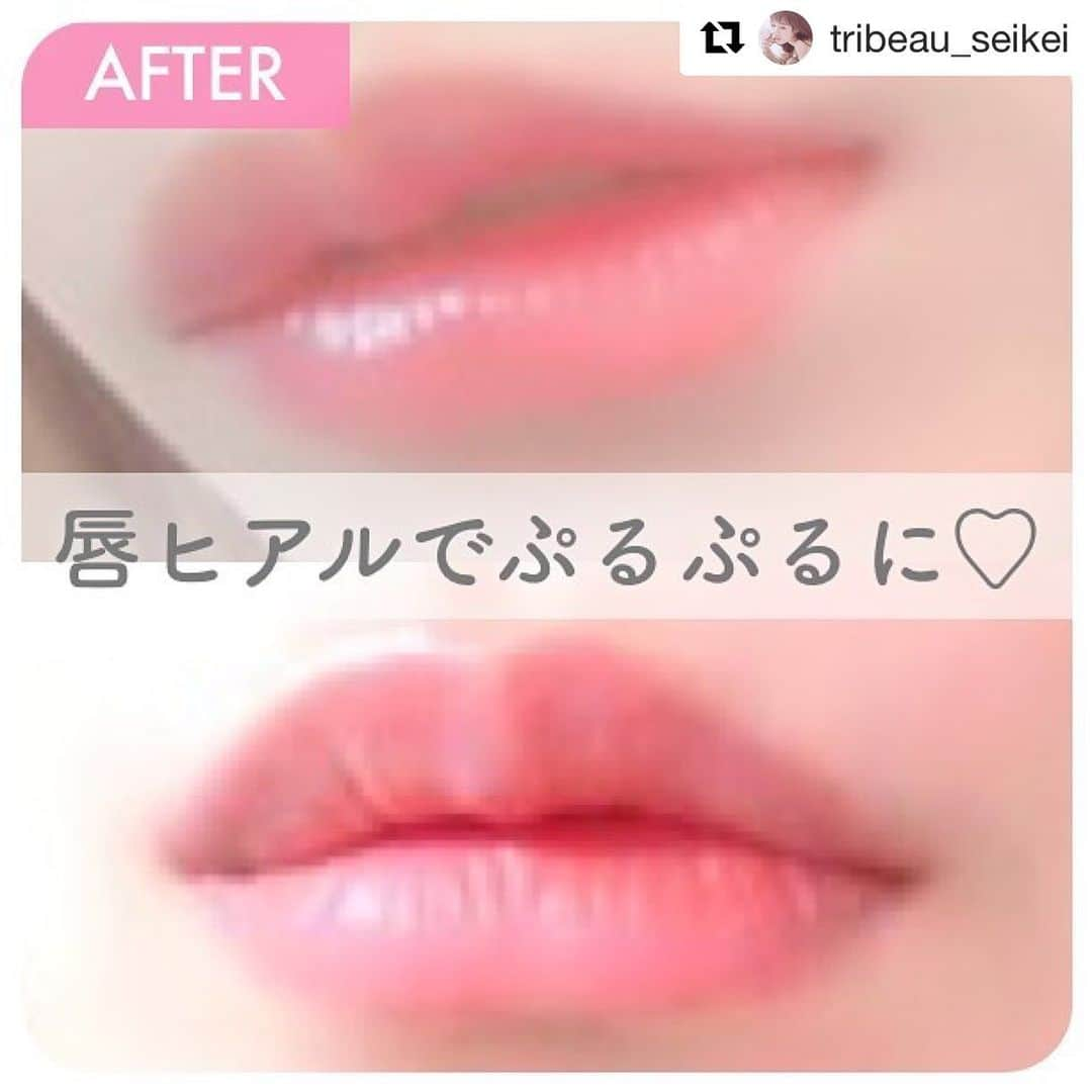 恵比寿フィラークリニックさんのインスタグラム写真 - (恵比寿フィラークリニックInstagram)「大人気のスマイルリップ💋💋💋✨ ㅤㅤㅤㅤㅤㅤㅤㅤㅤ 💞スマイルリップ💞 唇ヒアルロン酸＋口角ボツリヌストキシン セットで1回 20,000円 . ヒアルロン酸💉*ﾟﾟﾟﾟ唇をキュートなM字型に整えます❁保湿効果も✧ ボツリヌストキシン💉*ﾟﾟﾟﾟ口角を下げる口角下制筋に働きかけ、緊張をゆるめて口角を下げる力を弱めます❁  ㅤ もちろん唇ヒアルロン酸だけの施術でもOK💉 ㅤㅤㅤㅤㅤㅤㅤㅤㅤ 唇ヒアルロン酸🌹 【ドクターリフェイスライト】 0.1cc 3000円 今ならご新規様 最初の0.1cc 2,500円！  0.6cc注入の場合、2,500＋3,000円×5＝17,500円！ ㅤㅤㅤㅤㅤㅤㅤㅤㅤ ボリュームのある理想の唇へ！ ご相談お待ちしております。 ━━━━━━━━━ ㅤㅤㅤㅤㅤㅤㅤㅤㅤ ※注入後、稀に内出血が起こる可能性がありますが、約2週間で徐々に引いていきます。 ※注入部位に強い力が加わりますと、へこみ・変形を引き起こす原因になりかねません。施術から1カ月間は、極力触らないよう配慮をお願い致します。 ㅤㅤㅤㅤㅤㅤㅤㅤㅤ ご予約の際はInstagramをみたとお伝えください🥰💗 ㅤㅤㅤㅤㅤㅤㅤㅤㅤ ☆‥…━━━☆・‥…━━━☆ 【フィラークリニック】 お電話でのご予約・相談  0120-966-901（9:00-21:00/年中無休） ㅤㅤㅤㅤㅤㅤㅤㅤㅤ LINEでのご予約・相談も受付中♪ @ filler_c ☆‥…━━━☆・‥…━━━☆ ㅤㅤㅤㅤㅤㅤㅤㅤㅤ #Repost @tribeau_seikei with @get_repost ・・・ 唇ヒアルでぷるぷるに💗 ・ ｡*⑅୨୧┈┈┈┈┈┈┈┈┈୨୧⑅*｡ ・ 💬唇ヒアルロン酸注入＋口角ボトックス 🏥フィラークリニック 💰3万円代 🤕DT3日 🌟満足度★★★★ ・ ｡*⑅୨୧┈┈┈┈┈┈┈┈┈୨୧⑅*｡ ・  #ヒアルロン酸 #フィラークリニック #リップ #TRIBEAU #トリビュー #美容整形アプリ #二重 #二重埋没 #整形 #美容整形 #二重切開 #目頭切開 #鼻中隔延長 #ヒアルロン酸 #ボトックス #脂肪溶解注射 #小鼻縮小 #鼻尖形成 #プロテーゼ #渡韓 #韓国 #ダウンタイム #ルフォー  #プチ整形 #美容 #アイプチ #ビフォーアフター #小顔 #整形メイク」6月10日 12時22分 - filler_clinic