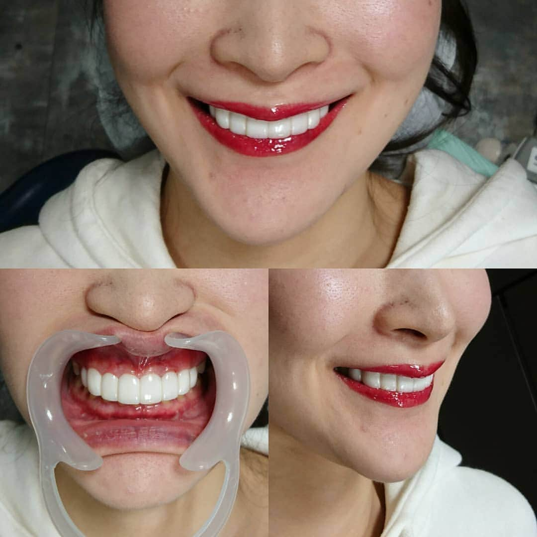 五十嵐一誠さんのインスタグラム写真 - (五十嵐一誠Instagram)「セラミックアート❗」6月12日 18時30分 - superdentist5