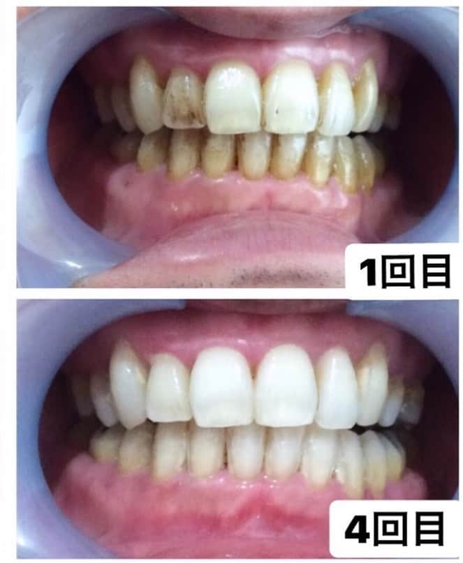 72WHITENING GYMさんのインスタグラム写真 - (72WHITENING GYMInstagram)「【たった一ヶ月ですごいことが起きる！】﻿ ﻿ 心斎橋店　ホワイトニングサロンです🌈﻿ 皆さまこんにちは！！ ﻿ ﻿ ﻿ たった四回（１ヶ月）で驚きの変化‼️﻿ ﻿ ここまで変わると相手に与える﻿ ご自身の印象もかなり変わりますね🥺✨﻿ ﻿ ﻿ ﻿ 歯は、見てないようで、﻿ 意外とみんな見てます👀﻿ ﻿ ﻿ もしかしたら、、、私大丈夫かな？と﻿ ﻿ 黄ばみが気になった方！﻿ ﻿ そんな黄ばみのお悩み当店にお越しいただければ解決できちゃいます🥰﻿ ﻿ 夏は輝く白い歯で🦷✨﻿ ﻿ ﻿ ﻿ 今なら30%off‼️﻿ ﻿ ﻿ ﻿ 圧倒的に結果が出るWHITENING GYM！！ ﻿ ﻿ ﻿ 皆さまのご来店心よりお待ちしております。 ﻿ ﻿ 他の変化のお写真もハイライトにまとめてます🥺是非、ご覧下さい🥰 ﻿ ================﻿﻿﻿ ﻿﻿﻿ @72whiteninggym_osaka ﻿﻿﻿ ﻿﻿﻿ 〒541-0057 ﻿﻿﻿ 大阪府大阪市中央区北久宝寺町２丁目６−１RE-017 504﻿﻿﻿ ﻿ ================﻿ ﻿ ﻿ ﻿﻿ #ホワイトニング #美しい歯 #第一印象#口元美人 ﻿﻿ #イメージアップ大作戦 #セルフホワイトニング大阪 #笑顔#フォトグラファー #歯 #白い歯目指す#心斎橋店 #駅近 #駅近ジム #パーソナルトレーニング」6月13日 15時49分 - 72whiteninggym_osaka