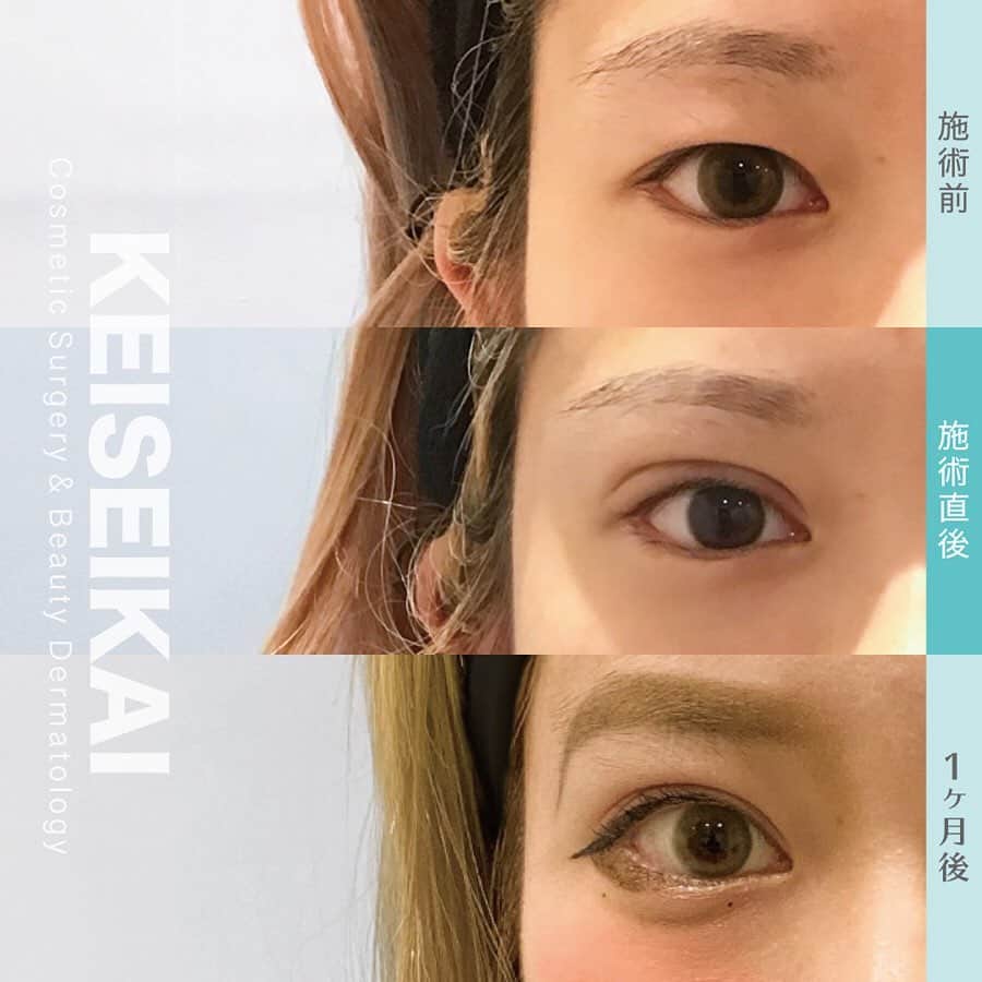 恵聖会クリニックさんのインスタグラム写真 - (恵聖会クリニックInstagram)「⠀ ＼アイプチいらずで楽チン生活😚／ ⠀ 埋没法を受けられる以前は、アイプチやアイテープを使って二重を作っていたという患者様からは、こんなお声をいただきます💡 ↓ ♡朝のメイクが楽になった ♡お泊まりですっぴんになれる ♡海やプールでアイプチが取れる心配をしなくていい ♡まぶたがかぶれなくなった などなど ⠀ 夏休みのはじめの方に受けたい🥺という方‼️ 7月のご予約開始してます😊 ⠀ ⠀ 💴MT埋没法3点留め/1年保証：46,000円(税抜) 🚿シャワー：当日から可能(顔は濡らさず) 🛁洗顔・メイク：翌日から可能 ⚠️リスク：腫れ・内出血・膿ほう・結膜浮腫・感染症・血腫 ⠀ #二重になりたい #可愛くなりたい #アイプチ卒業 #アイプチいらず #平行型 #平行型二重 #二重 #二重術 #二重整形 #二重まぶた #埋没法 #二重埋没 #二重埋没法 #埋没法二重術 #ビフォーアフター #症例写真 #恵聖会クリニック #恵聖モニター #整形 #美容整形 #プチ整形 #美容医療 #美容クリニック #美容外科 #美容皮膚科 #美容」6月17日 18時25分 - keiseikai