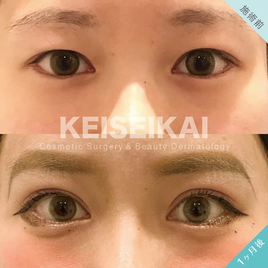 恵聖会クリニックさんのインスタグラム写真 - (恵聖会クリニックInstagram)「⠀ ＼アイプチいらずで楽チン生活😚／ ⠀ 埋没法を受けられる以前は、アイプチやアイテープを使って二重を作っていたという患者様からは、こんなお声をいただきます💡 ↓ ♡朝のメイクが楽になった ♡お泊まりですっぴんになれる ♡海やプールでアイプチが取れる心配をしなくていい ♡まぶたがかぶれなくなった などなど ⠀ 夏休みのはじめの方に受けたい🥺という方‼️ 7月のご予約開始してます😊 ⠀ ⠀ 💴MT埋没法3点留め/1年保証：46,000円(税抜) 🚿シャワー：当日から可能(顔は濡らさず) 🛁洗顔・メイク：翌日から可能 ⚠️リスク：腫れ・内出血・膿ほう・結膜浮腫・感染症・血腫 ⠀ #二重になりたい #可愛くなりたい #アイプチ卒業 #アイプチいらず #平行型 #平行型二重 #二重 #二重術 #二重整形 #二重まぶた #埋没法 #二重埋没 #二重埋没法 #埋没法二重術 #ビフォーアフター #症例写真 #恵聖会クリニック #恵聖モニター #整形 #美容整形 #プチ整形 #美容医療 #美容クリニック #美容外科 #美容皮膚科 #美容」6月17日 18時25分 - keiseikai