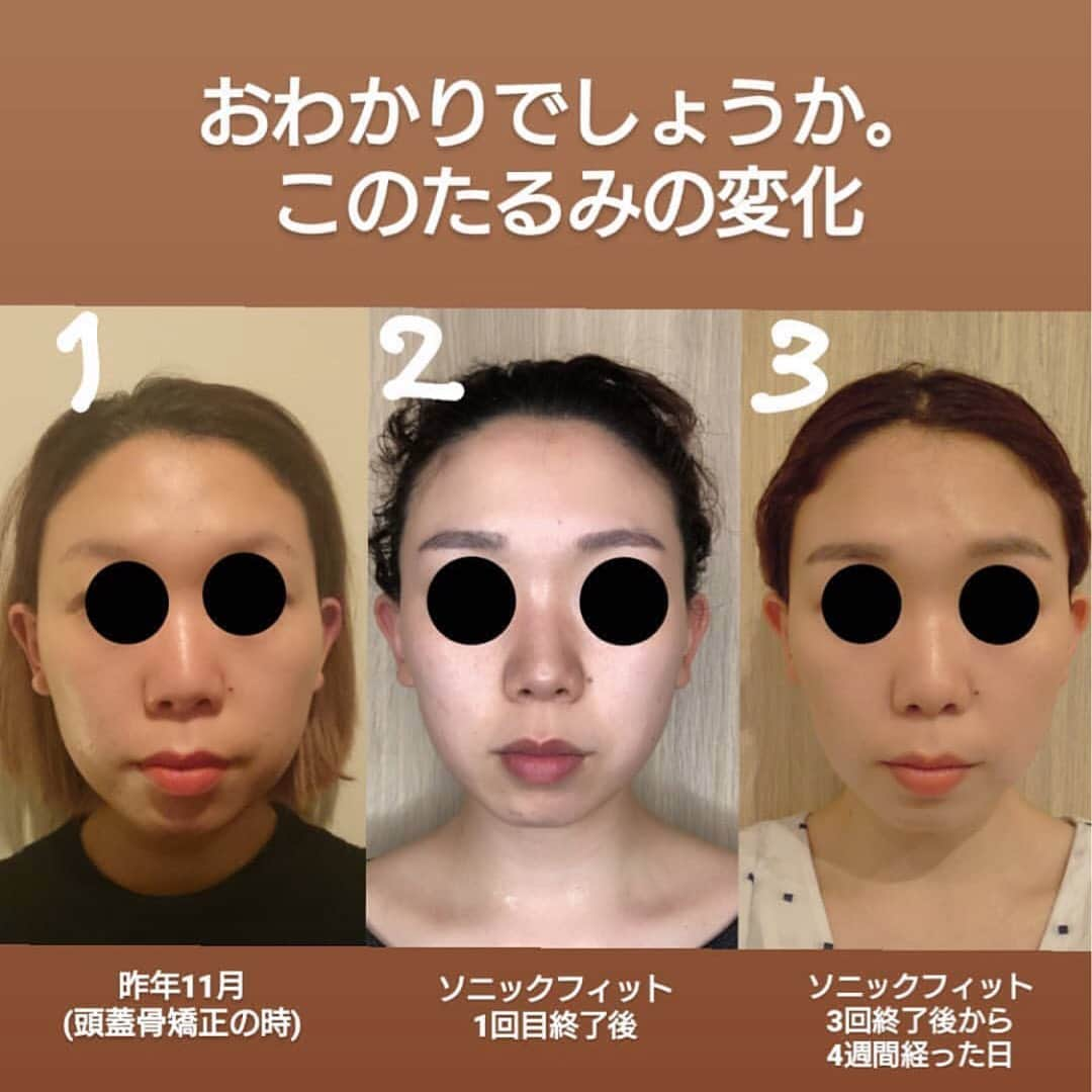 ROIさんのインスタグラム写真 - (ROIInstagram)「エステサロン『ROI Beaute』. ソニックフィットを3回施術したヘアメイクチーム室橋のbefore→after . . 「ソニックフィット」は肌質改善、首のシワやたるみ、高いリフトアップを実感していたただけるハイフを超えた最新美容マシンです😊✨. . ROIのHP内「ROI Beaute」やROI Beauteのアカウント@roibeaute プロフィールアドレスからもご予約頂けます💕. . 【ROI Beaute/7.８月ご予約に関して】. 現在、７月８月のご予約が取りづらい状況となってしまい、お客様にはご不便ご迷惑をおかけしております。. ７月は残り僅か、８月はまだご予約可能なお日にちございます💐. 是非ご予約をお待ちしております😊✨. #ROIBeaute #ソニックフィット #アンチエイジング . . . . . 改めましてみなさま﻿ 本日は、お忙しいであろうお昼過ぎ﻿ @momoko.kawakami さんの﻿ #ソニックフィット 施術#実況中継 の﻿ #インスタライブ 視聴頂きありがとうございました🙇♡﻿ ﻿ 桃子さんがご自身でインスタライブを行い、﻿ その模様を私が自分のアカウントから﻿ インスタライブするという﻿ シュールなインスタライブでした😂笑﻿ ﻿ まあなにはともあれ、﻿ いろんな方にソニックフィットを﻿ 知って頂けたかと思うととっても嬉しい！﻿ ありがとうございます✨﻿ ﻿ そしてここで、載せようと思って﻿ ずっと載せそびれていた﻿ 自分の#ビフォーアフター の#比較写真 載せます。﻿ 目元はピーって感じですがご了承下さい🙇﻿ だってストーリーズに載せた黒丸の目玉は﻿ 何人かに気になると言われたから🤣笑﻿ ﻿ ちなみに、眉は#韓国 で#アートメイク したので﻿ これまた変化が。笑﻿ ﻿ 私の場合は、﻿ 1回目施術﻿ ｜﻿ ｜3週間後﻿ ↓﻿ 2回目施術﻿ ｜﻿ ｜4週間後﻿ ｜ここら辺で肌の変化を実感！﻿ ↓﻿ 3回目施術﻿ ﻿ 今現在、3回目を終えてから1ヶ月経ちました。﻿ ﻿ ﻿ ﻿ ﻿ ご質問ありましたらいつでも聞いてください♡﻿ @roibeaute 一同お待ちしております！﻿ ﻿ ﻿ そして桃子さんご来店ありがとうございました！﻿ 次も楽しみにしております♡﻿ ﻿  #最新機器 #美容機器 #おすすめです #sonicfit #roihairmake #roibeaute #beautysalon #thenew #liftup #미용기기 #미용 #에스테틱 #이뻐 #안티에이징 #최신 #리프트업 #헤어메이크」7月13日 16時21分 - roi_salon