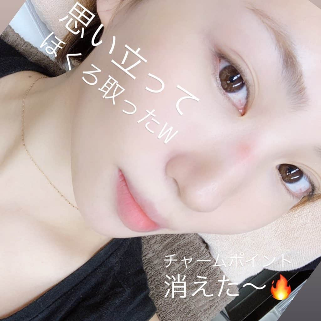 増田有華さんのインスタグラム写真 - (増田有華Instagram)「・ 取る予定一切無かったんだけど 取れば？の一言でmyチャームが瞬殺で消えました。 私の27年間の相方、さようなら。  なんだかつるんとしたような、スッキリ！ 昨日まであったのにね。不思議ダネ。 ・ ・ ・ #思いつき #取った顔も #見たくなったの #ちなみに #身体のほくろは #超チャームポイントなので #取りませんでぴた #みんなの知らないほくろ〜 #笑 #瞬殺 #30秒いらないくらい #麻酔しなくても #全く痛くなかった #無痛 #ほくろで運勢変わるって #ホント？ #また欲しくなったら #マジックで書く。 #でいいよね #ほくろ #黒子 #ほくろ除去」7月15日 18時05分 - masuyuka_official