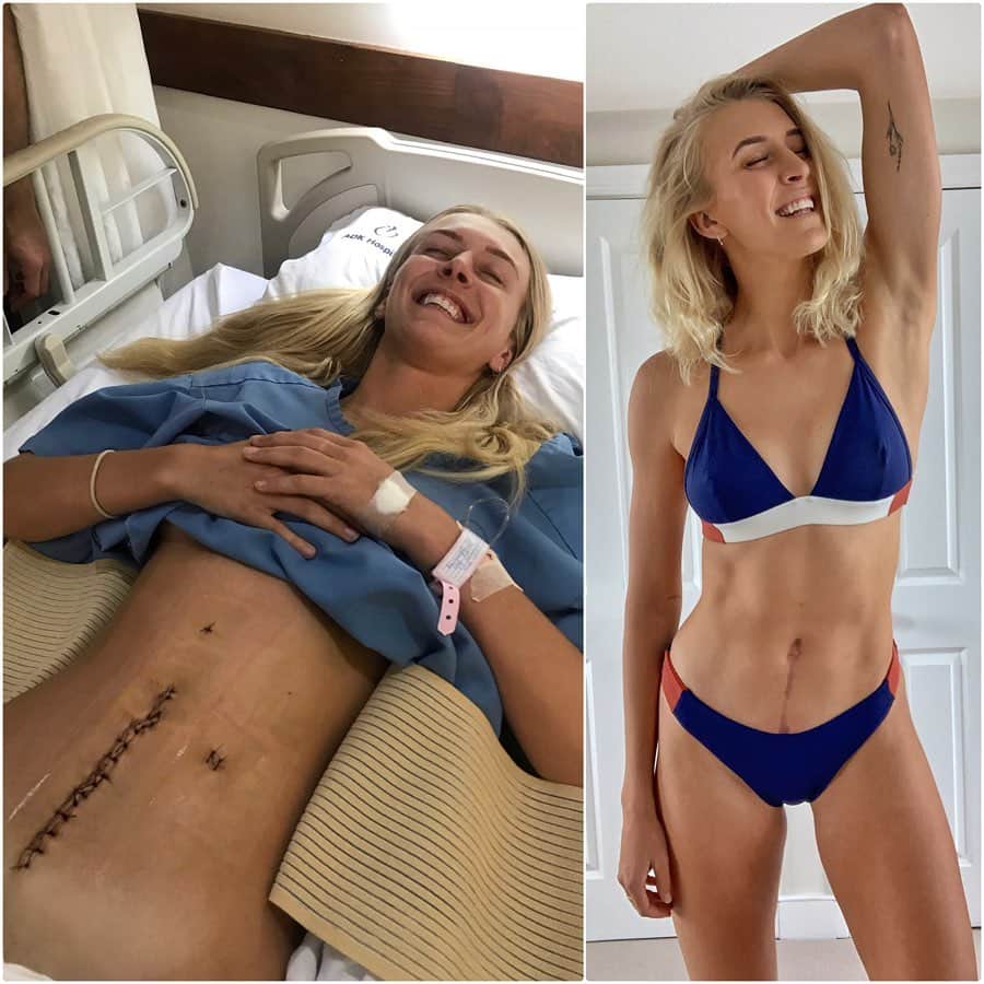 Zanna Van Dijkさんのインスタグラム写真 - (Zanna Van DijkInstagram)「My 6 Month Scar Progress! ☀️ Can you believe it’s been 6 months since my emergency surgery?! Time flies! 😱 If you guys know me you know I will be getting my scar out with pride this summer. It is a story on my skin, pretty badass and I love wearing it with confidence. However, I also want to take care of it! Ever since my surgery I have been massaging my scar with pure vitamin E oil and applying @kelocoteUK to my scar twice a day, every day. The massage helps break down the deeper scar tissue layers and the silicone based gel helps flatten and soften the external scar 👌🏼 I am currently using the UV @kelocoteUK gel to protect my scar in the sun, and in the hottest hours of the day I try to keep it out of the sun completely ☀️ I have had so many messages from you guys who said sharing my scar has helped you feel more confident with yours, so I really hope this post inspires you to join me and wear your scar with pride this summer! 💖 Bikini: @staywildswim ✌🏼 [paid partnership but I genuinely use it everyday!] #loveyourscar #proudofmyscar #scarredandproud #operationcomeback #twistedbowel #cecalvolvulus」7月16日 15時51分 - zannavandijk