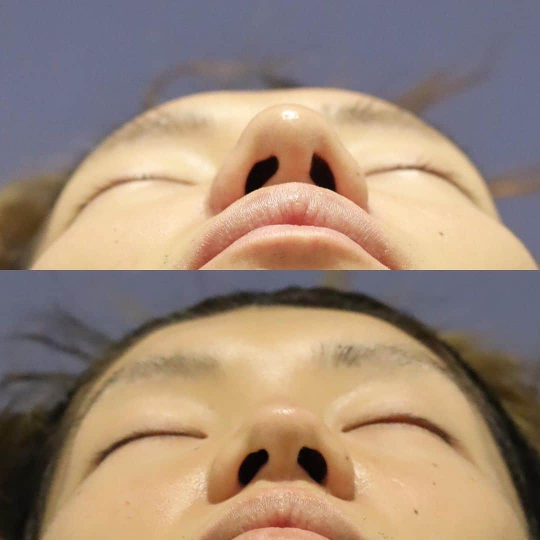 東京イセアクリニックさんのインスタグラム写真 - (東京イセアクリニックInstagram)「👃 鼻翼縮小でスッキリ小鼻に👨🏻‍⚕️✨ . 【鼻を小さくスッキリさせたい】 と言ったご希望の患者様🗣 ↓↓↓↓↓ 施術担当医:リョウ . . 写真上:after 3ヶ月 写真下:before . . ⚠️左右差・瘢痕のリスク 😷内出血・腫れ:数日 👨🏻‍⚕️抜糸:5-7日後 鼻翼縮小 ¥300000【税込】 . 施術が初めての方には、保証が付いております🌟 . カウンセリングは無料ですので お気軽にお問い合わせ下さい💁🏼‍♀️💁🏼‍♂️ . #銀座#ginza  #iseaclinic#イセアクリニック #吉種克之  #美容整形 #美容外科 #美容皮膚科 #美容 #整形 #プチ整形 #鼻整形  #鼻翼縮小 #鼻翼 #eライン  #綺麗になりたい#可愛くなりたい」6月24日 17時39分 - iseaclinic