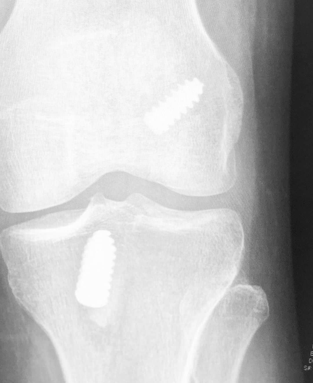 ジェイミー・アレクサンダーさんのインスタグラム写真 - (ジェイミー・アレクサンダーInstagram)「Huge thanks to my amazing surgeon, Dr. Laith Jazrawi (and team) for my new, incredible, bionic knee! 😂🙌🏻💙💙💙 #nyulangone #nyusportsmedicine」6月29日 2時05分 - jaimiealexander