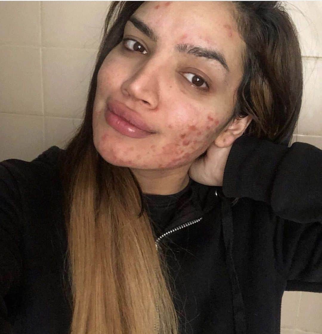 Teen Vogueさんのインスタグラム写真 - (Teen VogueInstagram)「In a picture perfect Instagram world where flawless skin is seen as the norm, these 6 influencers get real and raw about their journeys with acne. At the link in bio, @RocioCeja_ , @EmilyKeel_ , @EmeraldxBeauty, @KaiserCoby, @SkinWithLea, and @TheStyleBoro talk to Teen Vogue about their experiences with #acne and what makes them feel beautiful.」6月30日 0時18分 - teenvogue