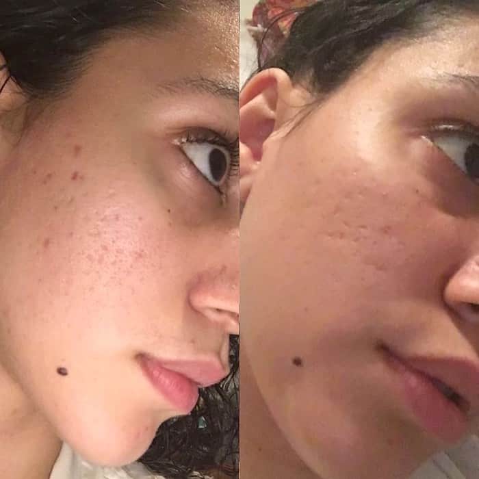 KORA Organicsさんのインスタグラム写真 - (KORA OrganicsInstagram)「Thank you Brittany @9_sommer for sharing your #MyKora experience with us! (Swipe left for Brittany’s testimonial!) 🦋 We’re so happy our products have helped reduce the appearance of your acne scars, helping you to feel “more confident” in your own skin! ✨ Have you experienced a #skintransformation since using KORA Organics? Tag @koraorganics and #MyKora in your before and afters. We 💖 sharing real results from real people! #KORAOrganics #MindBodySkin #NoniGlow」7月17日 9時25分 - koraorganics