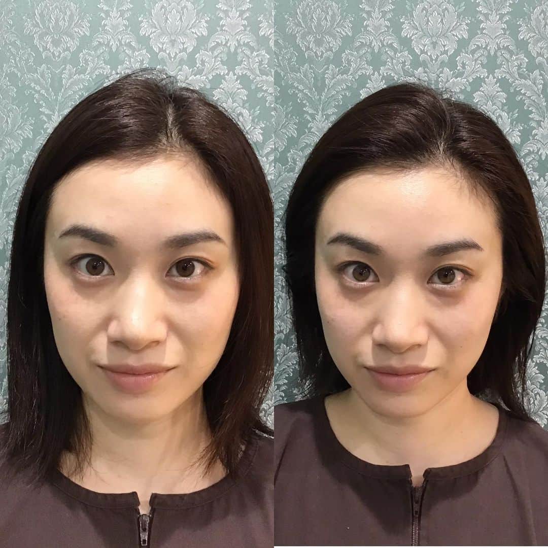 鈴木芳奈さんのインスタグラム写真 - (鈴木芳奈Instagram)「初！美容鍼！ 気にはなっていたけど、、、 やっとやってみました。 こりゃ、なんや。 わお。私はむくみやすい体質らしいのでこの鍼がとても合うらしく、施術後のシュッとした感じにびっくり！首コリ肩コリも激しい私は最強なものに出逢ってしまった。  #ハリッチ #美容鍼灸 #女優鍼 ＃actress #beauty」7月2日 18時11分 - tachibana_kanna