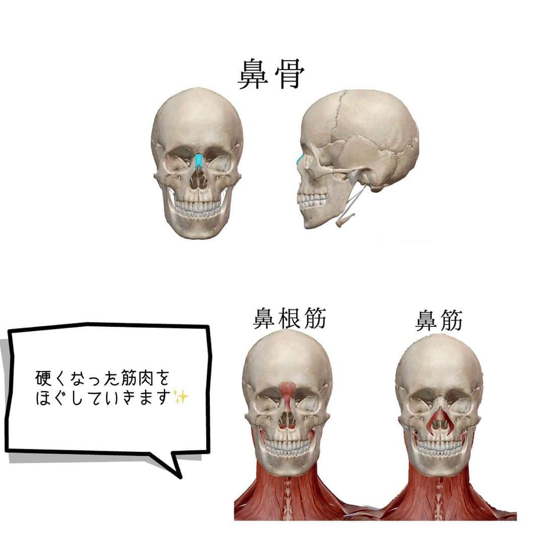 小顔科学研究所 さんのインスタグラム写真 - (小顔科学研究所 Instagram)「自分で簡単にできる👌✨﻿ 鼻を高くする方法🌟﻿ ﻿ 鼻が高くなりたい、、﻿ そんな方へオススメのセルフケアです！﻿ ﻿ 鼻の筋肉には﻿ 鼻筋・鼻根筋という筋肉があります。﻿ この筋肉が硬くなる事で﻿ 鼻の骨に張り付き圧迫して鼻を低くしてしまいます。﻿ ﻿ 鼻が高くなるマッサージ👌﻿ ﻿ ①鼻の両サイドに指の腹を置き、﻿ 軽く挟み上に引き上げる様に﻿ 30秒優しくマッサージしましょう！﻿ ﻿ ②目頭から指1本下のところにくぼみがあるので﻿ そこに指を置き、鼻の骨のキワを下から上に﻿ 押し出すように30秒圧を加えます。﻿ ﻿ これを４分程行なって下さい。﻿ ※強さは痛みのない程度で💫 ﻿ 1日2回朝・夜（お風呂上がり）に﻿ 毎日やってみてください🎶﻿ テレビを見ながらもできます(^o^)👌﻿ ﻿ コツコツしていくと﻿ 鼻が高くなりお顔に立体感が出てきますよ🎵﻿ ﻿ 『立体的な小顔』『美人鼻』を﻿ 手に入れましょう\ ( ˆ ˆ ) /🎶﻿ ﻿ 是非お試し下さい✨﻿﻿ ﻿﻿ また現在小顔科学研究所の美容鍼は﻿ 初回5,000円(税別)で受けて頂けます！﻿﻿﻿﻿﻿﻿ 詳しくは2枚目の画像QRコードから﻿﻿﻿﻿﻿﻿ お気軽にお問い合わせ下さいませ♪﻿﻿﻿﻿﻿﻿﻿﻿﻿﻿﻿﻿﻿﻿﻿﻿ ﻿﻿﻿﻿﻿﻿﻿﻿﻿﻿﻿﻿﻿﻿ ﻿﻿ ﻿﻿ ┈┈┈┈┈┈┈┈┈┈┈┈┈┈┈┈┈┈﻿﻿﻿﻿﻿﻿﻿﻿﻿﻿﻿﻿﻿﻿﻿﻿﻿﻿﻿﻿ ﻿﻿﻿﻿﻿﻿﻿﻿﻿﻿﻿﻿﻿﻿ ﻿﻿﻿﻿﻿﻿﻿﻿﻿﻿﻿﻿ ﻿﻿﻿ #小顔 #小顔矯正 #骨盤矯正 #小顔科学研究所 #痛くない小顔矯正 #小顔サロン #小顔効果 #小顔はつくれる #芸能人御用達 #美容 #整体 #美容整体  #表参道小顔矯正 #名古屋小顔矯正  #心斎橋小顔矯正 #福岡小顔矯正 #天神小顔矯正 #美容情報 #鼻を高くしたい﻿ ﻿ #小顔マッサージ #セルフマッサージ﻿」7月3日 12時40分 - kogaokagaku