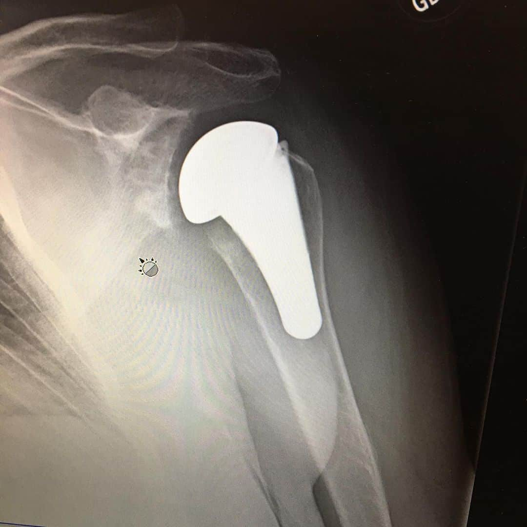 ドット=マリー・ジョーンズさんのインスタグラム写真 - (ドット=マリー・ジョーンズInstagram)「TWO WEEK CHECK UP AND MY NEW SHOULDER IS DOING GREAT!! HURTS BUT DOING GOOD  @bridgettcjones SAYS MY GIANT EAR BUD! 😥😋🙏🏻❤️💪🏻」7月5日 2時18分 - dotmariejones