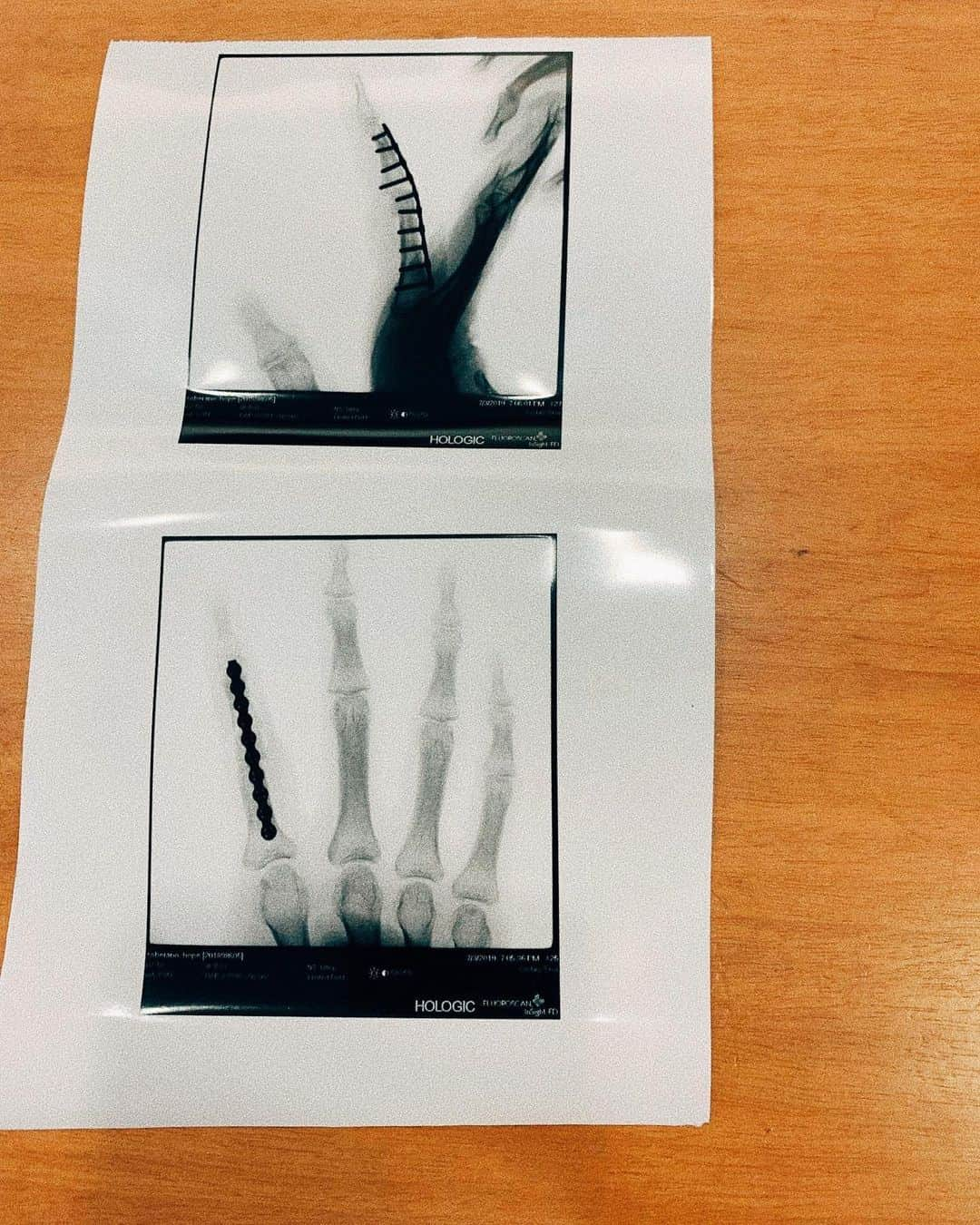 リザ・ソベラーノさんのインスタグラム写真 - (リザ・ソベラーノInstagram)「⚠️ Caution graphic content ⚠️ Finally done with my last procedure in hopes of fixing my finger. Unfortunately it will never function the same way again but atleast its there! 😅 Sorry for sharing such gruesome photos. 😬」7月6日 11時15分 - lizasoberano