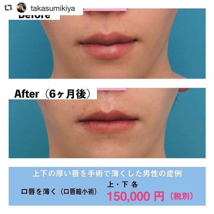 高須クリニック名古屋院さんのインスタグラム写真 - (高須クリニック名古屋院Instagram)「#repost @takasumikiya via @PhotoAroundApp  上下の厚い唇を手術で薄くした男性の症例 ・ 20代男性の患者様で、厚い唇を薄くしたいというご要望でした。 診察させていただいたところ、確かに上下の唇がやや厚めでぷっくり膨らんでおり、いわゆる「タラコ唇」のような状態でした。 また、骨格的にやや口元が前方に出ており、それによって余計に唇が厚いのが強調されていました。 患者様のご要望通り、手術で上下の唇を薄くすることになりました。 ・ 手術は局所麻酔下に行い、平均くらいの厚さになるように、上下の唇の厚みを3～4割程度薄くしました。 手術後は、上下の唇が程よく薄くなり、唇が厚い印象がなくなりました。 ・ 【料金】 ●口唇を薄く（口唇縮小術）：150,000円（税別） ※料金は2019年6月24日現在 ※保険適用外、自由診療 ・ 【リスク・副作用など】 ●口が閉じにくい・歯が出る（口唇を薄くしすぎた場合） ●仕上がりのわずかな左右差（完璧なシンメトリーは不可） ●仕上がりが完璧に自分の理想の形にならないことがある ・ 【ご予約・お問い合わせ】 名古屋院☎︎ 052-564-1187 名古屋院📱 @takasuclinic_nagoya ↑名古屋院インスタのプロフィール画面からも直接コンタクトが取れます📲 https://www.takasu.co.jp/ ・ ・ #高須クリニック #高須クリニック名古屋院 #高須幹弥 #高須英津子 #美容整形 #整形 #二重 #埋没法 #二重切開 #ヒアルロン酸 #鼻 #ニキビ跡 #たるみ #太もも痩せ #シワ #ほうれい線 #毛穴 #目 #整形したい #美容好きな人と繋がりたい #可愛くなりたい #綺麗になりたい #平行二重 #末広二重 #プチ整形 #二重整形 #目尻切開 #目頭切開 #ビフォーアフター」7月7日 16時24分 - takasuclinic_nagoya