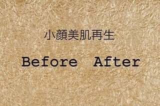 神崎紗衣さんのインスタグラム写真 - (神崎紗衣Instagram)「東京中央美容外科世田谷院で、TCB式小顔美肌再生とボトックス注射を受けてから１ヶ月経ったぁ✨ もう違和感も全く無いし、ビフォーアフターで比べるとシュッとしたの分かるかなぁ？ . . 山崎院長が丁寧に施術してくれたおかげ！感謝です🐰💉🏥💊 . .  @tcbsetagaya @dr.yamazaki #東京中央美容外科世田谷院#TCB式小顔美肌再生#美容外科#世田谷#池尻大橋#田園都市線#美容#アンチエイジング#小顔#ミスワールド#ミスワールドジャパン#小顔#ボトックス#リフトアップなら東京中央美容外科#美容整形なら東京中央美容外科#pr」7月7日 13時53分 - kanzaki_sae