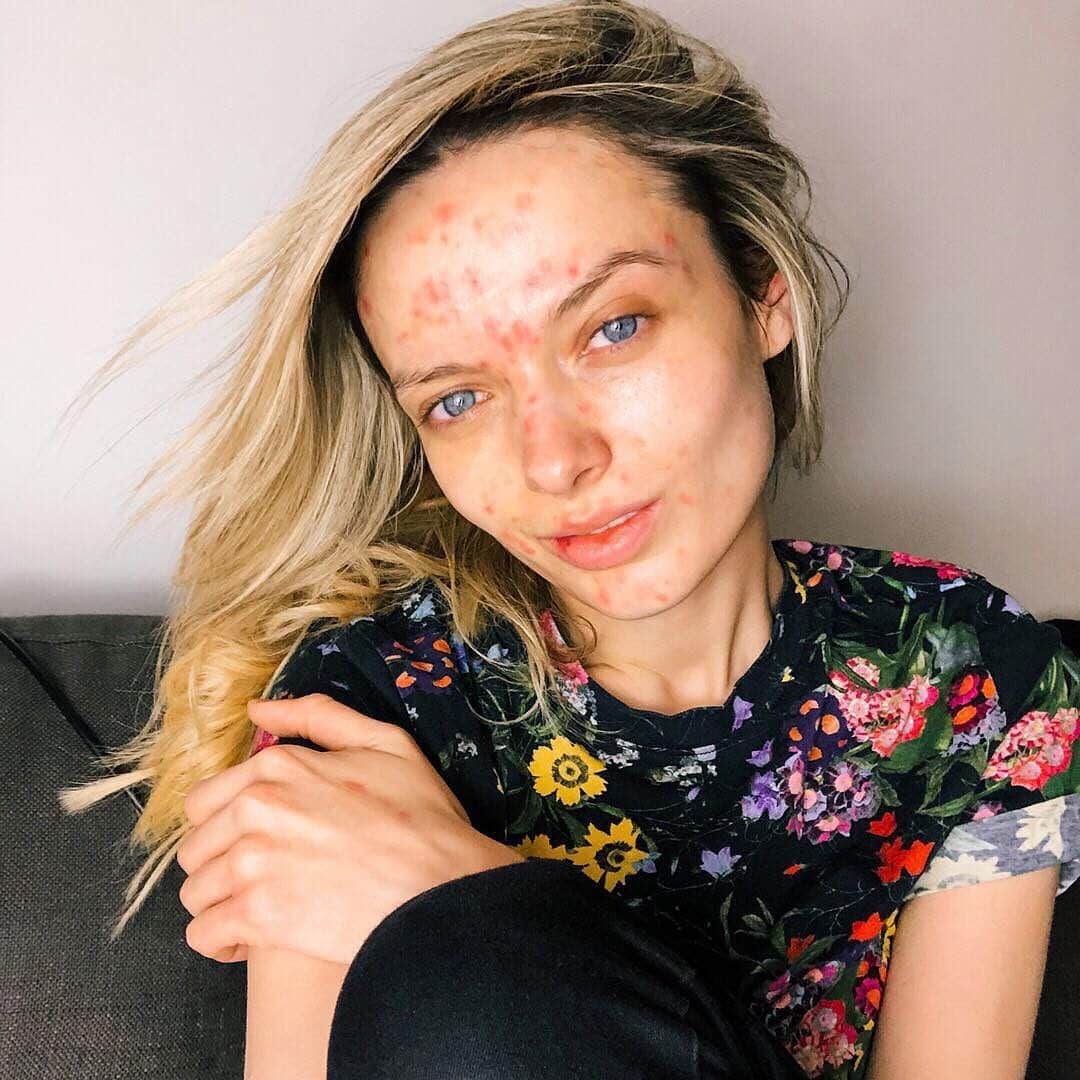 Teen Vogueさんのインスタグラム写真 - (Teen VogueInstagram)「"I'm more than my skin on a good day and a bad day; your skin does not define you as a person." ❤️ At the link in bio, @mypaleskinblog shares 10 things she wishes people knew about acne.」7月8日 9時01分 - teenvogue