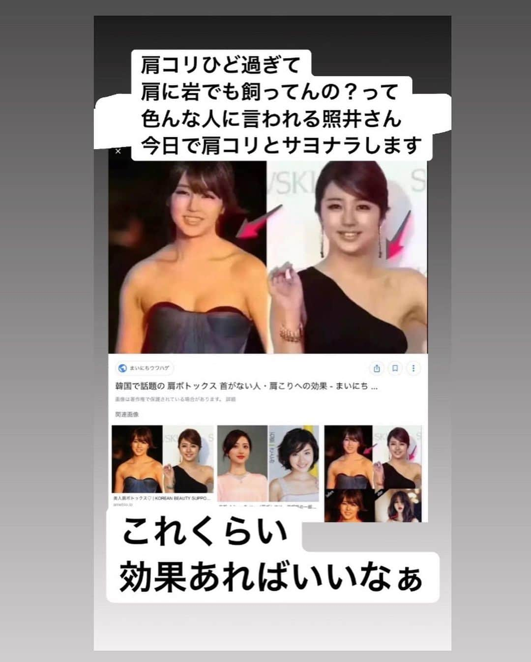 照井和希さんのインスタグラム写真 - (照井和希Instagram)「大のコンプレックスを改善しに 前回も脇のボトックスでお世話になった 《 @sbc_kamata 》へ！ 肩コリで出来た 肩のモッコリを解消すべく駆け込んだ😭 ． 肩コリやと感じひんくらいもう 凝り固まってて カチカチ状態のまま生きてきて 気付けばラクダのコブ みたいになってた私の首回り🤣🤣🤣爆笑 色んな人に指摘され出して マッサージしたり ストレッチとか本間色々試したけど最早自力では改善せず… 華奢な女の子らしい首元に憧れを持つようになってw コンプレックス化しててん( ；꒳； )！！！！！ ． 前回行った時にボソッと先生に悩み話してたから 今回は肩のボトックスに挑戦する事にしました。 (号泣感激拍手喝采スタンディングオベーション) ． 肩のボトックス 両肩で ¥29800 私は笑気麻酔プラスしたけど、麻酔は別料金です😌✨ 笑気麻酔が効きにくくい体質みたいな照井やけど 肩のボトックスはまじで痛みゼロでした。 たぶん個人差はあると思うけど 余裕ですぐ終わった！👌🏽 ． ． コメントでもあったけど これは 肩幅が狭くなる施術ではありません。 調べれば出てくると思うから個人で調べて欲しいんやけど 肩の凝り改善と同時に、肩のモッコリやハリが和らいで 首が長く見える、モッコリが無くなる ってイメージかなぁ。‪(*´꒳`∩)‬？？？ ． ． すぐには効果現れへんと思うから 数日、数週間様子見てビフォアフター撮ります🤔💯♥️ ． いやぁ。悩みをぶっ潰すって何て幸なの。 今まで以上に生きやすい。美意識向上でしかない。。。 今回も担当してくれた #佐藤由仁 先生 @sbc_satoyuto は 二重手術、小顔リフトアップが 得意らしいから 気になる人は是非相談してみてね！！ ． 興味のある人は #佐藤由仁のデカ目術 #Dr佐藤由仁の糸リフト にたくさん写真載ってるから見てみて下さい🙈🌺🌈 YouTube・tiktokもやってるみたいよ🧚‍♀️ とにかく明るくて本当いい人やから まじっっっで 安心して任せられる🤣💕✨笑笑 ． ． ． #脇ボトックス #夏 #美容 #美容ネタ #美容記事 #レポート #美容レポ #整形 #美容クリニック #ダイエット #クリニック #糸リフト #リフトアップ #二重 #ヒアルロン酸 #二重整形 #リフトアップ効果 #肩ボトックス」7月10日 22時04分 - kazu24ki