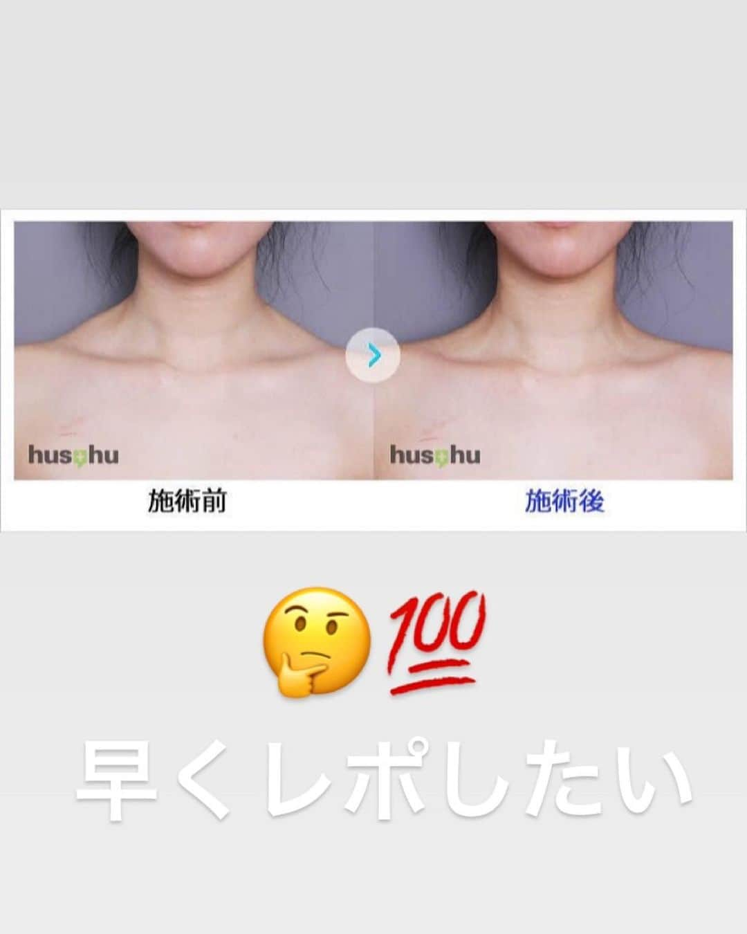 照井和希さんのインスタグラム写真 - (照井和希Instagram)「大のコンプレックスを改善しに 前回も脇のボトックスでお世話になった 《 @sbc_kamata 》へ！ 肩コリで出来た 肩のモッコリを解消すべく駆け込んだ😭 ． 肩コリやと感じひんくらいもう 凝り固まってて カチカチ状態のまま生きてきて 気付けばラクダのコブ みたいになってた私の首回り🤣🤣🤣爆笑 色んな人に指摘され出して マッサージしたり ストレッチとか本間色々試したけど最早自力では改善せず… 華奢な女の子らしい首元に憧れを持つようになってw コンプレックス化しててん( ；꒳； )！！！！！ ． 前回行った時にボソッと先生に悩み話してたから 今回は肩のボトックスに挑戦する事にしました。 (号泣感激拍手喝采スタンディングオベーション) ． 肩のボトックス 両肩で ¥29800 私は笑気麻酔プラスしたけど、麻酔は別料金です😌✨ 笑気麻酔が効きにくくい体質みたいな照井やけど 肩のボトックスはまじで痛みゼロでした。 たぶん個人差はあると思うけど 余裕ですぐ終わった！👌🏽 ． ． コメントでもあったけど これは 肩幅が狭くなる施術ではありません。 調べれば出てくると思うから個人で調べて欲しいんやけど 肩の凝り改善と同時に、肩のモッコリやハリが和らいで 首が長く見える、モッコリが無くなる ってイメージかなぁ。‪(*´꒳`∩)‬？？？ ． ． すぐには効果現れへんと思うから 数日、数週間様子見てビフォアフター撮ります🤔💯♥️ ． いやぁ。悩みをぶっ潰すって何て幸なの。 今まで以上に生きやすい。美意識向上でしかない。。。 今回も担当してくれた #佐藤由仁 先生 @sbc_satoyuto は 二重手術、小顔リフトアップが 得意らしいから 気になる人は是非相談してみてね！！ ． 興味のある人は #佐藤由仁のデカ目術 #Dr佐藤由仁の糸リフト にたくさん写真載ってるから見てみて下さい🙈🌺🌈 YouTube・tiktokもやってるみたいよ🧚‍♀️ とにかく明るくて本当いい人やから まじっっっで 安心して任せられる🤣💕✨笑笑 ． ． ． #脇ボトックス #夏 #美容 #美容ネタ #美容記事 #レポート #美容レポ #整形 #美容クリニック #ダイエット #クリニック #糸リフト #リフトアップ #二重 #ヒアルロン酸 #二重整形 #リフトアップ効果 #肩ボトックス」7月10日 22時04分 - kazu24ki