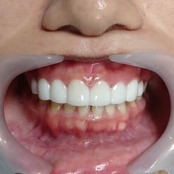 五十嵐一誠さんのインスタグラム写真 - (五十嵐一誠Instagram)「スーパーベニア  どんな歯と歯並びを直したかは スワイプで❗」7月12日 6時44分 - superdentist5