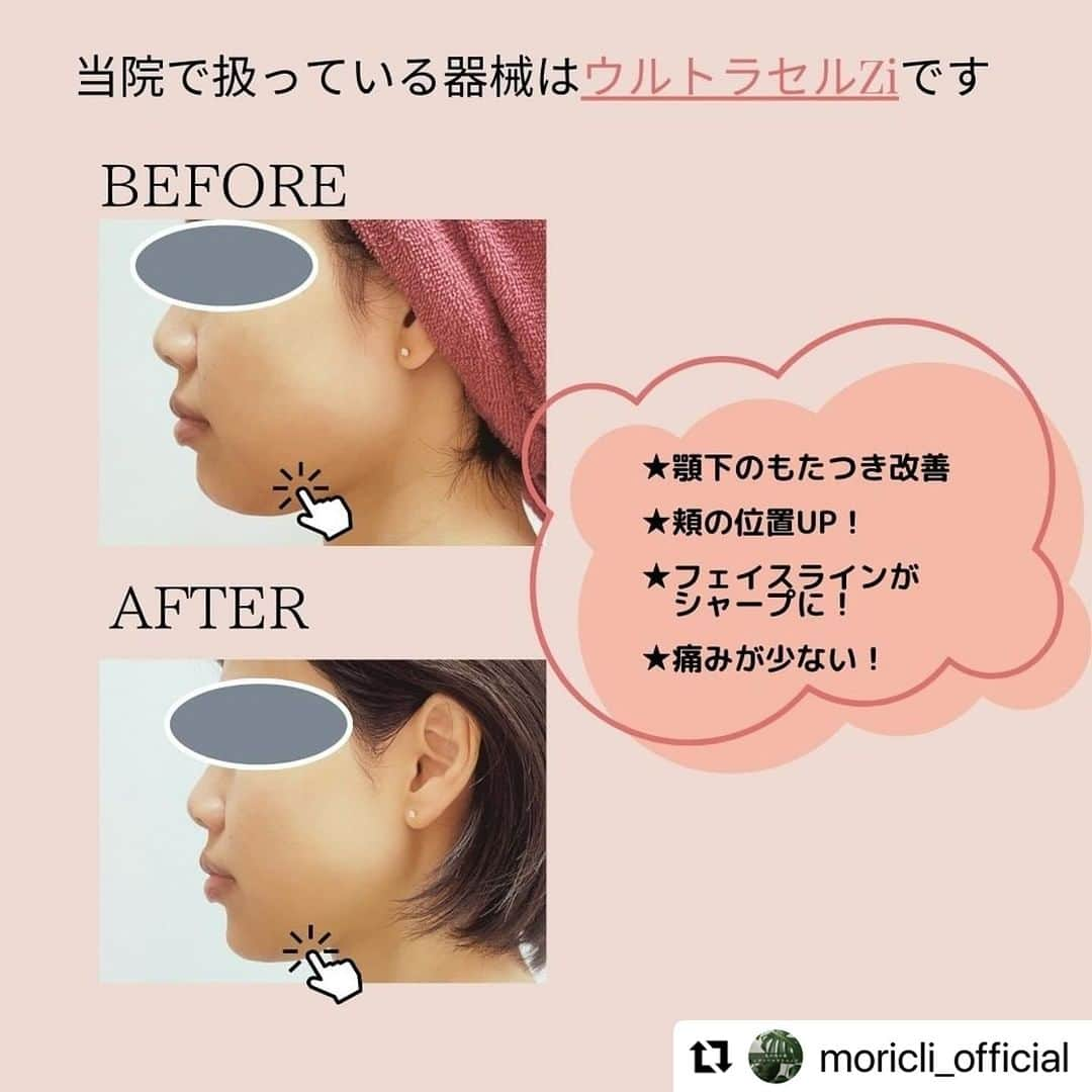 宋美玄さんのインスタグラム写真 - (宋美玄Instagram)「#Repost @moricli_official with @use.repost ・・・ HIFUのキャンペーン 12月限定20％オフになります！！  ドット・リニアどちらもご希望のデザインに合わせて照射させて頂きます。  頬はこけているが二重顎が気になる方や、 フェイスラインのたるみが気になる方 一度ぜひお試しください！  #レディースクリニック #産婦人科 #婦人科検診 #ピル #緊急避妊薬 #アフターピル #30代美容 #40代美容 #美容皮膚科 #美容クリニック #美容 #スキンケア  #ニキビ #にきび #ニキビ跡 #老け顔#アンチエイジング #毛穴 #シミ #シワ #たるみ #老け顔 #ルメッカ #ウルトラセルzi #ハイフ #東京美容皮膚科 #丸の内美容皮膚科 #東京 #丸の内 #銀座」12月15日 17時54分 - mihyonsongkobe