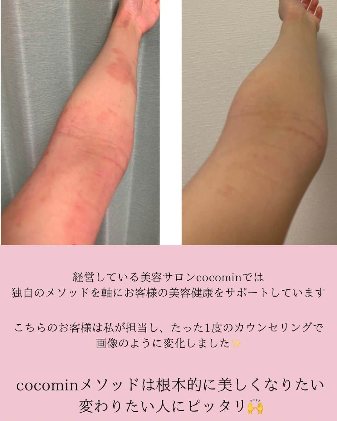 水紀華さんのインスタグラム写真 - (水紀華Instagram)「怪しい東洋中医学論✍️今回は“あげまん”についてです🦋✨ ⁡ ⁡ ⁡ ⁡ 『これはどういった状態！？』 『この悩みについて分析してほしい！』 ⁡ リクエストも大募集です🫶 気軽にコメントで教えて下さい♡ ⁡ ⁡ ⁡ ⁡ 【スクール詳細】 ⁡ ・LINEオープンチャットを利用します ⁡ ・匿名で参加できます ⁡ ・COCOMIN LIFEにて 　カテゴリー【クリスマスBOX】の中から 　1個購入すると参加できます ⁡ ・cocomin LINEに購入したスクリーンショットを 　送って下さい ⁡ ・販売は12/22 12時まで⚠️ ⁡  #東洋医学 #怪しい東洋中医学論 #体質改善ダイエット #あげまん　#あげまん女子 #ハイスペ婚 #出世 #お金持ちになる方法  ⁡」12月16日 12時46分 - mizuki_ah