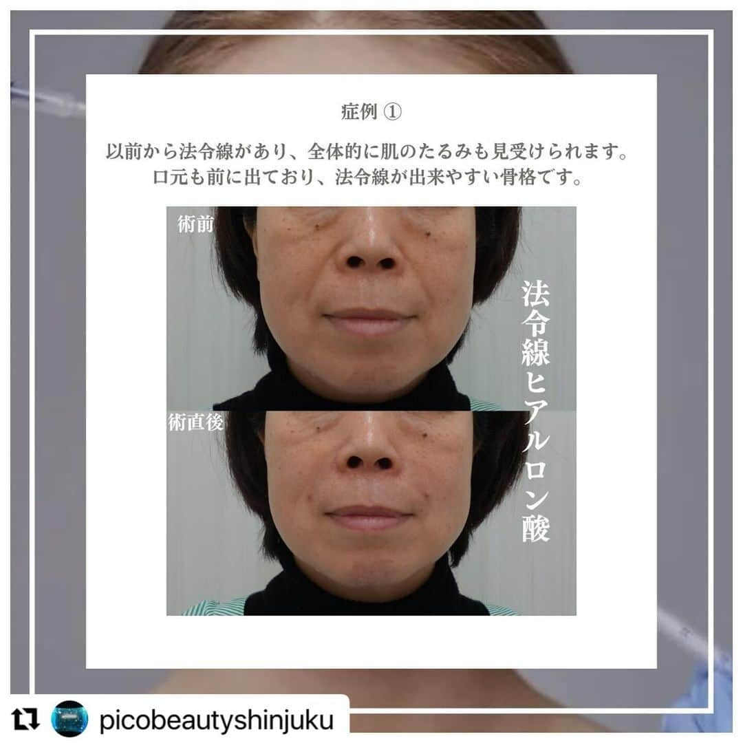 YAG BEAUTY CLINICさんのインスタグラム写真 - (YAG BEAUTY CLINICInstagram)「#Repost @picobeautyshinjuku with @use.repost ・・・ 法令線ヒアルロン酸とは？？ どんな骨格やどんな原因でできるのか？？ご紹介しています💁‍♀️ 自分は何に当てはまるかな？ 是非一度当院へご相談下さい💜  ご予約・お問い合わせにつきましては当院までお電話お待ち致しております🙇‍♀️ 💎PICO BEAUTY CLINIC💎 〒160-0022 東京都新宿区新宿3-29-17新盛堂ビル8階 📲0120-900-253  #美容クリニック #美容外科 #美容皮膚科 #美容看護師 #picobeautyclinic #ピコビューティークリニック #ピコレーザー #新宿東口 #新宿 #ピコシュア #ピコトーニング #ピコフラクショナル#ピコスポット #シミ取り #シミ取り放題 #ピコシュアならピコビューティークリニック  #肌育  #アンチエイジング　#スキンケア #美白ケア #ダウンタイム #若返り #肌治療 #肌悩み #たるみ #シワ #ほうれい線 #ヒアルロン酸とは #ヒアルロン酸注入   @yagbeauty_official」11月24日 12時28分 - yagbeauty_official