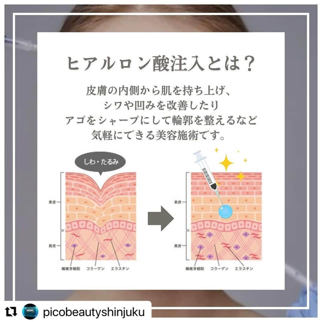 YAG BEAUTY CLINICさんのインスタグラム写真 - (YAG BEAUTY CLINICInstagram)「#Repost @picobeautyshinjuku with @use.repost ・・・ 法令線ヒアルロン酸とは？？ どんな骨格やどんな原因でできるのか？？ご紹介しています💁‍♀️ 自分は何に当てはまるかな？ 是非一度当院へご相談下さい💜  ご予約・お問い合わせにつきましては当院までお電話お待ち致しております🙇‍♀️ 💎PICO BEAUTY CLINIC💎 〒160-0022 東京都新宿区新宿3-29-17新盛堂ビル8階 📲0120-900-253  #美容クリニック #美容外科 #美容皮膚科 #美容看護師 #picobeautyclinic #ピコビューティークリニック #ピコレーザー #新宿東口 #新宿 #ピコシュア #ピコトーニング #ピコフラクショナル#ピコスポット #シミ取り #シミ取り放題 #ピコシュアならピコビューティークリニック  #肌育  #アンチエイジング　#スキンケア #美白ケア #ダウンタイム #若返り #肌治療 #肌悩み #たるみ #シワ #ほうれい線 #ヒアルロン酸とは #ヒアルロン酸注入   @yagbeauty_official」11月24日 12時28分 - yagbeauty_official