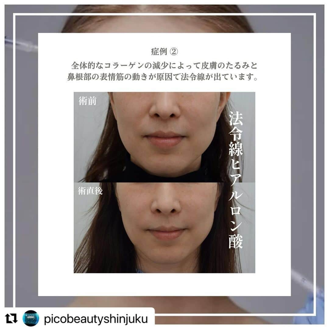 YAG BEAUTY CLINICさんのインスタグラム写真 - (YAG BEAUTY CLINICInstagram)「#Repost @picobeautyshinjuku with @use.repost ・・・ 法令線ヒアルロン酸とは？？ どんな骨格やどんな原因でできるのか？？ご紹介しています💁‍♀️ 自分は何に当てはまるかな？ 是非一度当院へご相談下さい💜  ご予約・お問い合わせにつきましては当院までお電話お待ち致しております🙇‍♀️ 💎PICO BEAUTY CLINIC💎 〒160-0022 東京都新宿区新宿3-29-17新盛堂ビル8階 📲0120-900-253  #美容クリニック #美容外科 #美容皮膚科 #美容看護師 #picobeautyclinic #ピコビューティークリニック #ピコレーザー #新宿東口 #新宿 #ピコシュア #ピコトーニング #ピコフラクショナル#ピコスポット #シミ取り #シミ取り放題 #ピコシュアならピコビューティークリニック  #肌育  #アンチエイジング　#スキンケア #美白ケア #ダウンタイム #若返り #肌治療 #肌悩み #たるみ #シワ #ほうれい線 #ヒアルロン酸とは #ヒアルロン酸注入   @yagbeauty_official」11月24日 12時28分 - yagbeauty_official