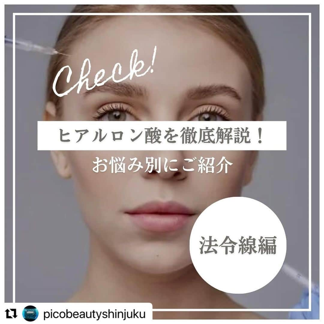 YAG BEAUTY CLINICのインスタグラム：「#Repost @picobeautyshinjuku with @use.repost ・・・ 法令線ヒアルロン酸とは？？ どんな骨格やどんな原因でできるのか？？ご紹介しています💁‍♀️ 自分は何に当てはまるかな？ 是非一度当院へご相談下さい💜  ご予約・お問い合わせにつきましては当院までお電話お待ち致しております🙇‍♀️ 💎PICO BEAUTY CLINIC💎 〒160-0022 東京都新宿区新宿3-29-17新盛堂ビル8階 📲0120-900-253  #美容クリニック #美容外科 #美容皮膚科 #美容看護師 #picobeautyclinic #ピコビューティークリニック #ピコレーザー #新宿東口 #新宿 #ピコシュア #ピコトーニング #ピコフラクショナル#ピコスポット #シミ取り #シミ取り放題 #ピコシュアならピコビューティークリニック  #肌育  #アンチエイジング　#スキンケア #美白ケア #ダウンタイム #若返り #肌治療 #肌悩み #たるみ #シワ #ほうれい線 #ヒアルロン酸とは #ヒアルロン酸注入   @yagbeauty_official」