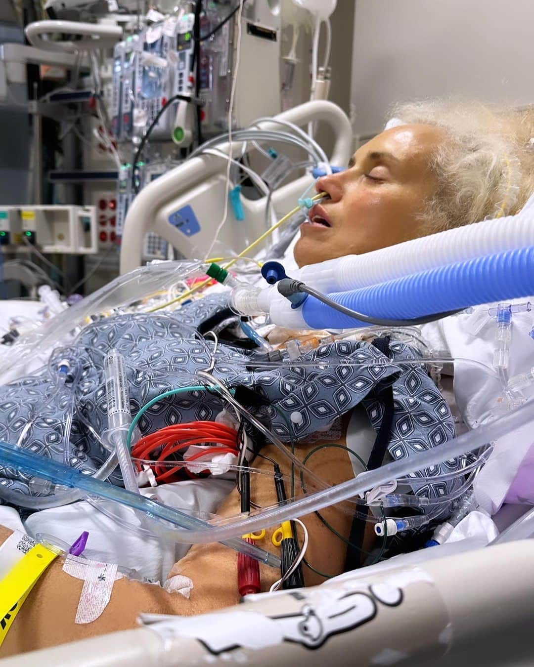 ジャスティン・マッテラのインスタグラム：「Cosa vuol dire Thanksgiving for me? 🦃 ➡️La possibilità di vedere mia sorella fare i primi passi dopo il arresto cardiaco di 18 gg fa. Ieri sera ho dormito in ospedale con lei ed è stato angosciante. Avevano appena fatto una tracheotomia dopo di essere stata intubata da una settimana. Giovedì scorsa avevano detto che non ce l’avrebbe fatta e pure un prete era arrivato a darle l’estrema unzione. 😩 Ci mancano ancora molti passi prima del trapianto del cuore ma io sono ottimista e grata ai medici bravissimi che la stanno curando.  🙏🏻Mia sorella non ha avuto una vita facile. ➡️ A 11 anni è stata diagnosticata con il linfoma di Hodgkin’s. Come cura hanno usato la radioterapia. Erano gli anni 80 e i raggi erano molto più forti. Questi raggi hanno bruciato sia il cuore che i polmoni di Jessica e di conseguenza  sono entrambi molto danneggiati. Ecco un po’ il perché dell’arresto cardiaco. ❤️‍🩹I costi delle cure sono altissimi negli Stati Uniti anche per chi ha l’assicutazione. Se potete o volete aiutarci lascio il link sotto e nelle stories. Grazie and…..happy Thanksgiving🙏🏻  https://gofund.me/4280bdf8 Link 🔗 in Bio !  #heartfailure #cardiacarrest #family #thanksgiving」
