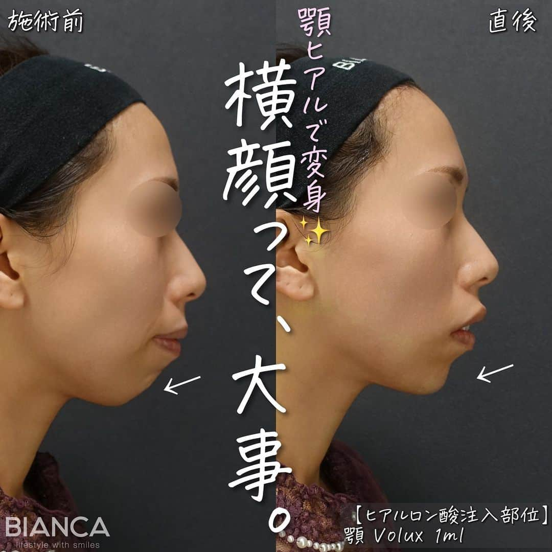 辻沢由有（BIANCA CLNIC 表参道院 院長）さんのインスタグラム写真 - (辻沢由有（BIANCA CLNIC 表参道院 院長）Instagram)「#dryuuヒアル　 【ヒアルロン酸で横顔美人✨】  顎のヒアルロン酸だけで 横顔の印象が一気に変わります☺️  治療時間、約10分👏 ヒアルロン酸でお顔を更に洗練🎉  どうなりたいかわからない方も こだわりがたくさんある方も 綺麗になりたい方、お任せください🥰  ✽.｡.:*・ﾟ ✽.｡.:*・ﾟ ✽.｡.:*・ﾟ ✽.｡.:*・ﾟ ✽.｡.:*・ﾟ  ✔︎顎ヒアルロン酸 ボラックス 1ml 77,000円＋税 別途施術料　22,000円＋税  ⏳治療時間: 10分 🗓持続期間: 1〜2年 😷腫れ・内出血: 数日程度 ⚠️リスク: 感染・血流障害・凹凸など  ✽.｡.:*・ﾟ ✽.｡.:*・ﾟ ✽.｡.:*・ﾟ ✽.｡.:*・ﾟ ✽.｡.:*・ﾟ  📝ご予約はwebが便利です✨ プロフィール欄のリンクからご予約ください。 ※医師指名可能（“大久保医師指名”をクリック） ※診察料はかかりません🙅‍♀️ ※表参道院勤務が9割となっています。  📍BIANCA CLINIC ※お電話頂くと自動音声通話に繋がります。 ✔︎表参道院 ☎️05018071593 東京都港区南青山5-11-10  南青山511ビル 2F ✔︎銀座院 ☎️05031964834 東京都中央区銀座1-8-19 キラリトギンザ12F  •診療時間 10:00〜19:00 •年中無休（年末年始を除く）   ✽.｡.:*・ﾟ ✽.｡.:*・ﾟ ✽.｡.:*・ﾟ ✽.｡.:*・ﾟ ✽.｡.:*・ﾟ  #eライン #横顔美人 #ヒアルロン酸 #アゴヒアルロン酸 #顎ヒアルロン酸」11月24日 15時08分 - i_am_yuu__