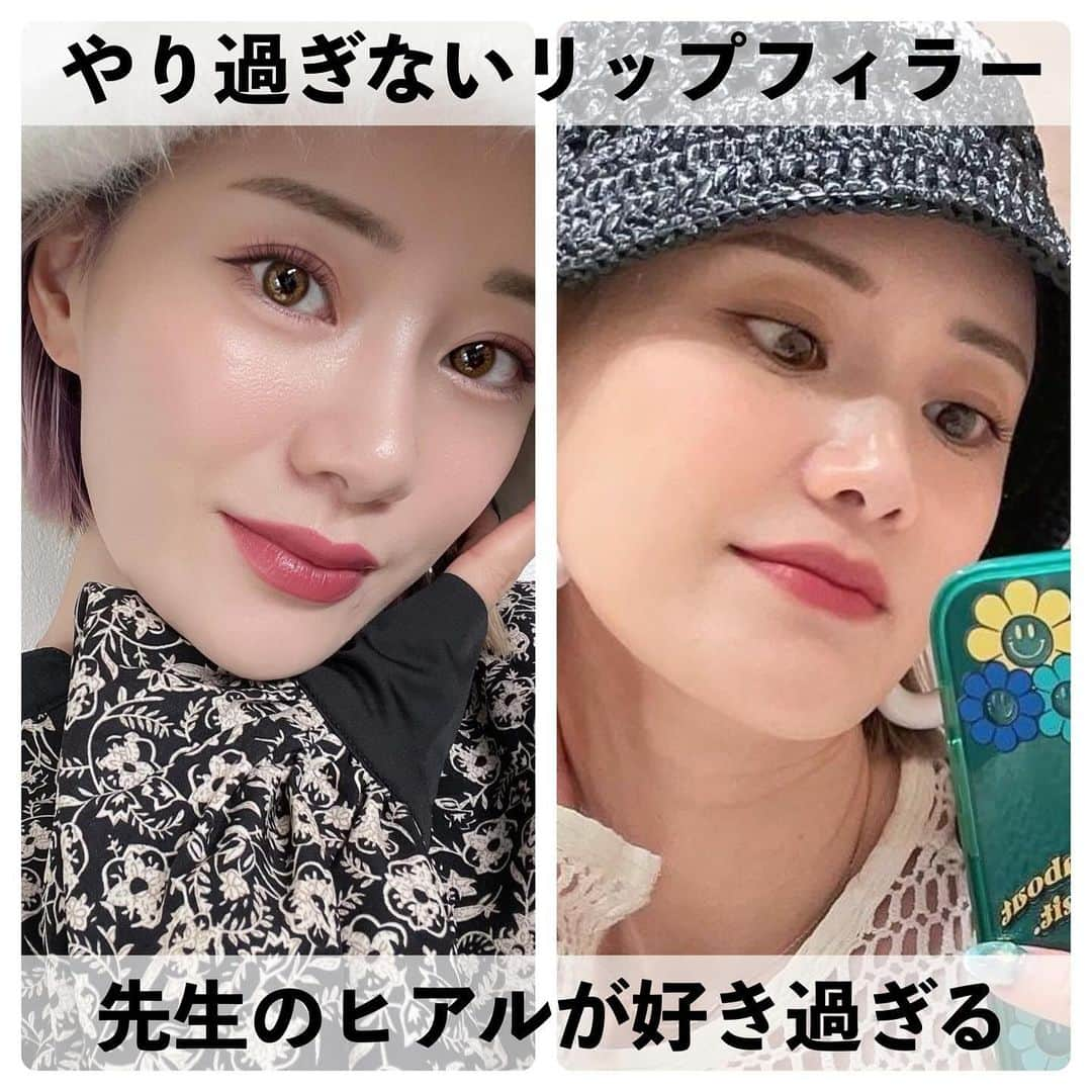 Arisaさんのインスタグラム写真 - (ArisaInstagram)「年々薄くなる唇💋にあたしの専門医 @dr.sayakanagao  さやか先生にリップフィラーやってもらいました🖤 もう2ヶ月前くらいになるんだけど、本当に やって良かった施術です👄 さやか先生はやり過ぎないフィラーに力を入れてる ので、本当ナチュラルな仕上がりでナチュラルに 綺麗に仕上げてくれます😭🙏 ヒアルロン酸は多分他にも名医は沢山いらっしゃると 思うのですが、私はこういう性格なのでさやか先生 だけにしかお願いしてないの🥹🥹🥹  そしてナチュラルだから、どこを変えたとか 周りからは一切気付かれず、何か綺麗になって いくよね〜と言われるのがまたさやか先生の 凄技なところ👍  痛さは笑気麻酔してたので、私的には余裕 がありました！！ 痛さレベルMAXなのは私的に鼻！ 鼻のボトックスと脂肪溶解は笑気麻酔してても 痛いわ😅wwww リップは多分笑気麻酔してなかったら絶対痛いw  また2024年もさやか先生に綺麗を手伝ってもらお💯🥹  #リップフィラー #リップヒアル #ヒアルロン酸注入  #ヒアルロン酸 #ヒアルロン酸注射」11月24日 16時45分 - saarariii