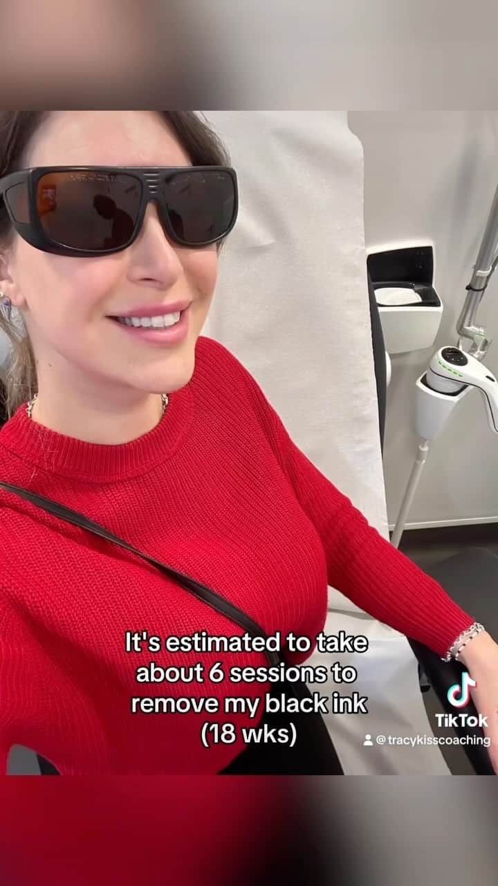 トレーシー・キスのインスタグラム：「Today I returned to @naamastudios to have my second tattoo removal appointment for the dots on my hand. You can use code "TRACYKISS50" for £50 off of your first laser treatment ✨  It has been literally the handiest tattoo in the world to use my hand dots as a ruler, but sadly my body decided to break down the ink, in an area of naturally high friction and use, which caused my tattoo to fade, blur and even disappear in places over time.   I did everything that I could to preserve my tattoo during healing, and even had the ink in my dots topped up multiple times, but it never stayed and so sadly the dots are going - but don't worry, I still adore bodyart and all of my other tattoos are with me for a lifetime!  Whilst tattoos used to be permanent, now there is the choice of laser tattoo removal which you can see takes just a matter of seconds to erase unwanted ink.   As each persons metabolism, lifestyle and recovery is different the amount of sessions needed will vary from person to person. It's predicted to take around 6 treatments for me to remove all of the ink, with a 3wk recovery inbetween to give my body the chance to break down the pigment and naturally remove it. Already I've seen such an improvement after my first session, so I was buzzing to have my second today.  What tattoos do you have that can benefit from a buzz and do-over? ✨   #tattooremoval #tattooremovalspecialists #tattooremovalbeforeandafter #lasertattoo #lasertattoo」