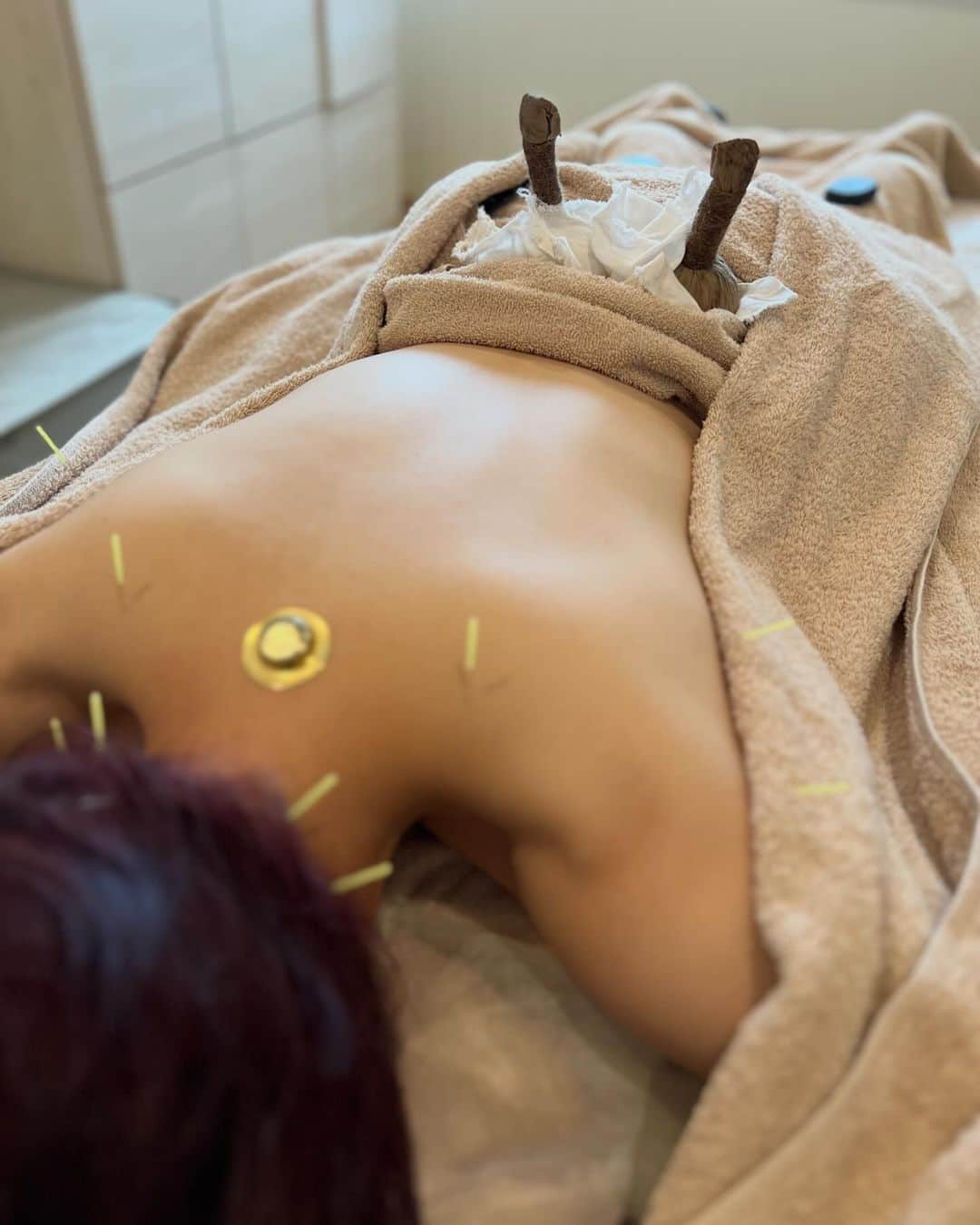 小川麻琴さんのインスタグラム写真 - (小川麻琴Instagram)「先日、温活専門鍼灸院の @meishin_haricchi さんに、身体のメンテナンスをしてもらいに行ってきたよ😌  東洋医学の考え方で身体を治療してくれるこのクリニックは、  まずよもぎ蒸しで全身を温め、その後に私の身体の状態に合わせて必要な箇所に鍼灸治療と温熱治療を行ってくれます。  私は特に首元、腰、脚の冷えが目立ったのでそこを中心に温めて治療をしてもらったよ✨  治療中はスタッフの方が今の身体の状態や、治療内容についてとっても丁寧に教えてくれるので凄く分かりやすかったです🥹❤️  元々冷え性で冬は特に身体の冷えを感じるのと、自律神経の乱れも気になってるので定期的に通って根本的な改善をしていけたらなって思ってます。  #東洋医学  #鍼灸院  #明心  #ハリッチ #よもぎ蒸し #温活」11月25日 8時43分 - 1029_makoto