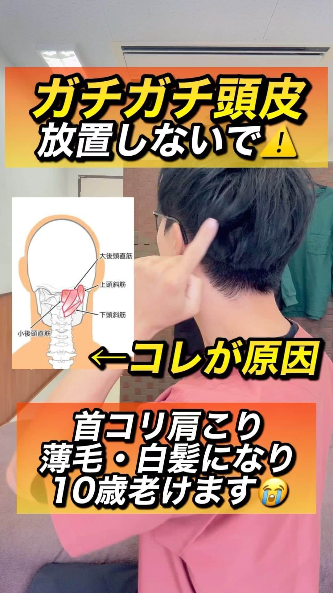 ゆう先生のインスタグラム：「【⚠️絶対放置しないで⚠️】ガチガチの頭皮をふにゃふにゃにして首コリ、肩こり、頭痛、顔のたるみを解消するエクササイズ‼️  他の投稿はこちらから @seitai_yu_kyoto  体操をやってくれたらぜひ🔥コメントで教えて下さいね😆  三日坊主から卒業したズボラ女性が多発中の完全無料の『愛美部』に入って健康キレイになるぞ！！という人はストーリーで愛美部情報をゲットして入部してきてね👍  共感、応援してくれる人はぜひ いいね👍 フォロー✨ 保存😎 お願いします😊✨ いいね👍保存が1番の励みになります！  ストーリーでは僕が日々やっているエクササイズの紹介やリール動画の解説、視聴者さんの質問回答&相談をしていますので必ず覗いてみてくださいね🔥  本質的に健康的になりたい人は保存マークがオススメです😆  ーーーーーーーーーーーーーーー 🔥情熱の治療家ゆう先生のプロフィール🔥 7年間の病院勤務で痛みや老化、美容の根本原因を解消せずに  『その場しのぎ』  のリハビリや処方をする現代医学に嫌気がさし、京都市伏見区で整体院悠を独立開業する。  スタッフのみお先生 @kyoto_seitai_yu  とともに京都のみならず全国からのお身体の悩みを改善し続けている。 ーーーーーーーーーーーーーーー  気になることがあればコメントに気軽にご質問くださいね😊 言いにくいことでしたら、直接DM頂いても大丈夫です👌  3日に1度22:00〜でInstagramで質問相談ライブ配信をしています！ぜひフォローして来てください😊  #首コリ #肩こり #頭痛 #頭皮ケア #顔のたるみ」