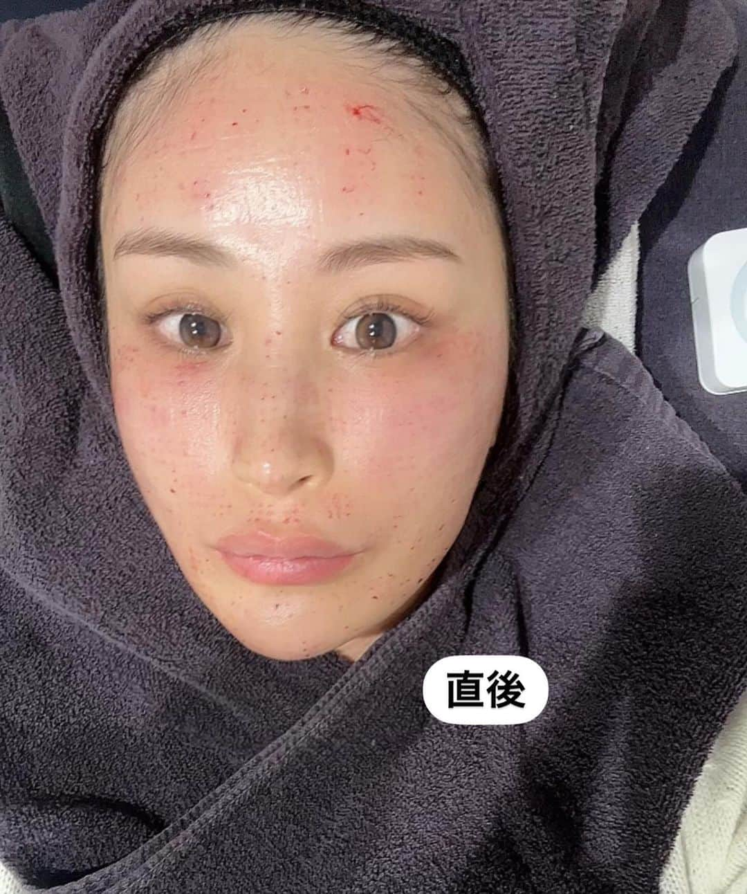 都築青空さんのインスタグラム写真 - (都築青空Instagram)「YAGBEAUTYCLINICで エクソソーム注射(水光注射)を受けました！ @yagbeauty_official  @yagbeautyclinic_shibuya  この写真ノーファンデだよ？！ 日焼け止めだけ！  エクソソームは、肌細胞を活性化させ、 肌のターンオーバーを正常に整えることで、 乾燥肌や敏感肌、にきびなど肌トラブルの改善や エイジングケアに効果が期待できる 今注目の薬剤💗  1週間ほどで内出血が引いていって みるみるうちにお肌の内側から ペカーーーンて光が発光するかんじ！！ 一回でだいぶ肌質かわって めちゃくちゃよくてまた受けたい😭😭  あおぞらのInstagramを見たで ご新規様 通常価格55,000円が50%off 既存のお客様は30%offで受けられます！ ※針麻酔代 (希望する方)別途8,800円  #YAGBEAUTY #エクソソーム水光注射 #美肌 #アンチエイジング #エクソソーム  #水光注射  #毛穴 #ニキビケア」11月27日 19時24分 - aozora723