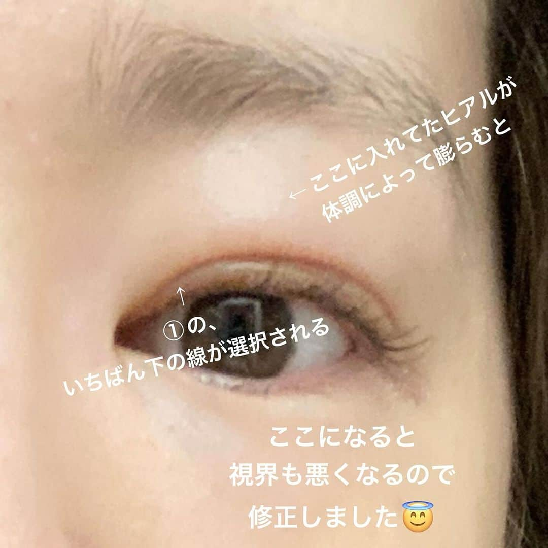 カブトムシゆかりさんのインスタグラム写真 - (カブトムシゆかりInstagram)「. たぶんいつもコメントしてくれている方々はワードが異国語に聞こえるかもしれませんがつらつら語ります🥸 . わたしの症例が眼瞼下垂治療になるのか謎ですが。 . . . もともとホリが深いのに、加齢で眼球下がってきて二重の線が三重になっちゃったりするのが嫌でヒアルロン酸入れていましたが、 . いつも入れてた上手いところじゃなくて池袋の予約とれる安いところにしたら入れすぎてしまい(2022年6月29日の投稿見返したら自分でも「入れすぎたかも」って自覚していた) . 溶け切らないヒアルロン酸が蓄積してきちゃって瞼が腫れぼったくなり元の線より下の二重になってしまったり、 . なにより視界が狭まっちゃって目が疲れるし、 瞼あげようとしておでこに力入れるからシワも寄るし首とか肩がとても疲れるようになっちゃって。 . それを治したくて眉下切開のカウンセリングに行ったところ「眉毛と目の間の余白なさすぎて切る皮膚ないから骨格的にも適応じゃないかなぁ、ビックリ目になっちゃうよ。」と言われーの。 . 形成外科での保険治療だと切開手術になるようで。 . 切開かぁ…切開なぁ…色々やってるけど絶妙にハードル高いんだよなぁ。笑 ってなりまして。 . 軽度には有効だという拳筋法の埋没に辿り着きました。 . 執刀医はほとんど毎日おめめの症例しかやってない先生ですが、わたしの瞼ヒアルロン酸でだいぶ硬くなってたみたいで手術中も「針が…針が…」って通すの大変そうでした😂 (あと私が麻酔効きずらくて覚めやすいから途中でだいぶ眼球暴れてて困らせた) . 術後も「あなた目動かすから大変だったよ！ヒアルロン酸の層にちょっとかぶっちゃってキツめに結ぶことになっちゃったから腫れと食い込み気になっちゃうかも！」って言われ(た気がする＠麻酔効いてたからうろ覚え) . 「術中かなり涙流してたから腫れるかも！たくさんお散歩してね！」って念を押され、先生がわざわざ言うくらいだからすごい腫れてるんだろうなぁと思いつつ鏡見て、 . ……やだ場末のキャバ嬢！！！！ . っていう感想の二重幅でしたが、 . もともとの二重からして幅が広いし、広さがあれば腫れる面積も多いわけだから気長に待とう。 「当日からバレない🥺」とかはどうせ嘘だろってかんじでとりあえず気長に２ヶ月様子見ます😇 . 幅はまだまだ派手で慣れないけど、 毎朝起きて「今日はどこの線だろう…」っていう二重ガチャなくなったのと、おでこに力入れなくても目ぱっちり開くのでそこはだいぶ楽になりそうです。 . . . わたしがめっちゃ検索魔でいろいろレポ見漁ってたので自分もかいてみました🫡 . 改めまして、しばらく腫れそうだしダウンタイム長引きそうなので「眠そう」って言わないでくださいおねがいします。笑 . あと「ガチャピン」も🥒 . . . １枚目は10日目すっぴんです。２枚目は１週間目にいつものメイクしてみたら顔ケバすぎてびっくりしたやつです。3枚目は11日目に薄めメイクでリベンジしたやつです。 . . . #眼瞼下垂 #目の上のヒアルロン酸 #目の上のくぼみ #目の上の窪み #埋没 #埋没DT #埋没経過 #ダウンタイム」11月28日 18時59分 - kabutomushiyukari