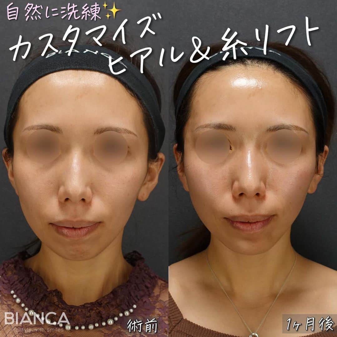 辻沢由有（BIANCA CLNIC 表参道院 院長）さんのインスタグラム写真 - (辻沢由有（BIANCA CLNIC 表参道院 院長）Instagram)「カスタマイズ治療💉  必要なところに、必要な分だけ。  治療内容は •ビアンカリフト10本 •こめかみ、頬、顎ヒアルロン酸 •顎ボトックス  1ヶ月後、 「何をしたかわからないけど、なんか小顔になったし、 肌つやんってしたし、輪郭きれいになってる✨？」  顎ボトックスなんて、とっても綺麗に効いてて これだけでテンションあがっちゃう😊💓💓  それこそがカスタマイズ治療のゴールです😉✨  ✽.｡.:*・ﾟ ✽.｡.:*・ﾟ ✽.｡.:*・ﾟ ✽.｡.:*・ﾟ ✽.｡.:*・ﾟ  ✔︎BIANCA LIFT  10本 3300,000円 🉐モニター 264,000円  ✔︎こめかみヒアルロン酸 ボリフト 1ml 税込84,700円 ✔︎あごヒアルロン酸 ボラックス 1ml 税込84,700円 ✔︎頬コケヒアルロン酸 ボリューマ 1ml 税込84,700円 別途施術料　税込24,200円  ✔︎顎ボトックス　10単位 660円/単位  😷腫れ・内出血: 数日程度 ⚠️リスク: 感染・血流障害・凹凸など  ✽.｡.:*・ﾟ ✽.｡.:*・ﾟ ✽.｡.:*・ﾟ ✽.｡.:*・ﾟ ✽.｡.:*・ﾟ  📝ご予約はwebが便利です✨ プロフィール欄のリンクからご予約ください。 ※医師指名可能（“大久保医師指名”をクリック） ※診察料はかかりません🙅‍♀️ ※表参道院勤務が9割となっています。  📍BIANCA CLINIC ※お電話頂くと自動音声通話に繋がります。 ✔︎表参道院 ☎️05018071593 東京都港区南青山5-11-10  南青山511ビル 2F ✔︎銀座院 ☎️05031964834 東京都中央区銀座1-8-19 キラリトギンザ12F  •診療時間 10:00〜19:00 •年中無休（年末年始を除く）   ✽.｡.:*・ﾟ ✽.｡.:*・ﾟ ✽.｡.:*・ﾟ ✽.｡.:*・ﾟ ✽.｡.:*・ﾟ  #eライン #横顔美人 #ヒアルロン酸 #アゴヒアルロン酸 #顎ヒアルロン酸 #糸リフト #こめかみヒアルロン酸 #ほほこけヒアル #輪郭整形 #フェイスラインのたるみ #糸リフト」11月29日 11時31分 - i_am_yuu__