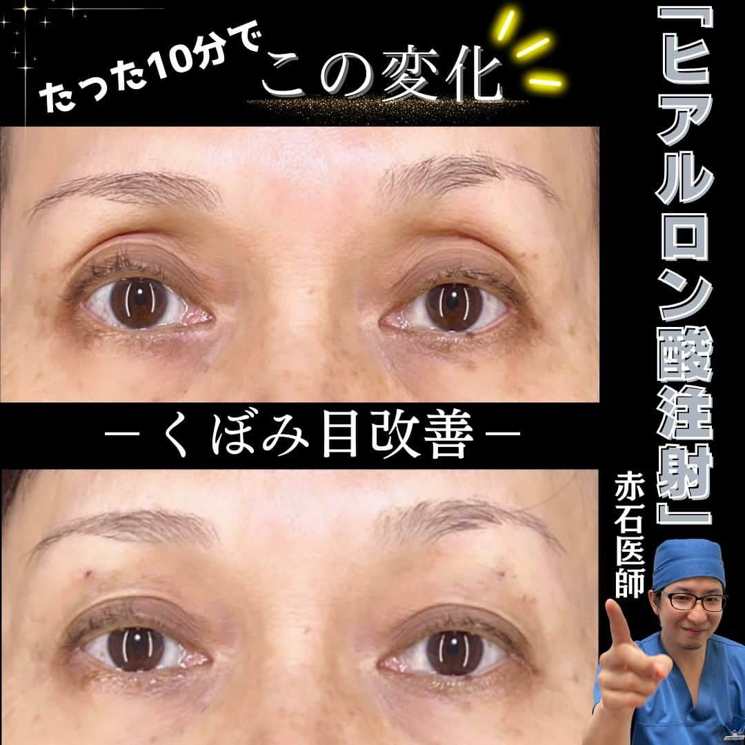 高須クリニック名古屋院のインスタグラム：「【赤石先生(@takasu_dr_akaishi)】によるくぼみ目修正の症例をご紹介😌👏  窪み目とは🔍  目の上や下が四んでいる状態のことを指します。 目の上や下が四む原因は、疲労、加齢による脂肪の減少、眼瞼下垂、先天的な脂肪不足等の要因があります。  ヒアルロン酸によるくぼみ目の修正は、傷跡の心配がなく両目あわせて⏰約10分程度⏰で施術が終了します😳✨  手術までは、、、と考えている方には、まずヒアルロン酸での修正が適応になる場合があるので、お悩みでしたら是非ご相談下さい🍀  【料金】 くぼみ目修正（ヒアルロン酸注射） ヒアルロン酸1本 ¥110,000（税込）  【リスク・副作用等】 内出血、左右差等  インスタ最後  . . . 【ご予約・お問い合わせ】 ☎️052-564-1187 📩nagoya@takasu.co.jp 📱@takasuclinic_nagoya ↑インスタのプロフィール画面からからも直接コンタクトがとれます📲 . 【名古屋院ドクターのアカウント🩺】 幹弥先生📱@takasumikiya 英津子先生📱@etsuko_takasu 森本先生📱@takasuclinic_dr.morimoto 笠井先生📱@takasu_dr.Kasai ゆかり先生📱@yukarinrinchan 吉武先生📱@dr_yoshitake 赤石先生📱@takasu_dr_akaishi」