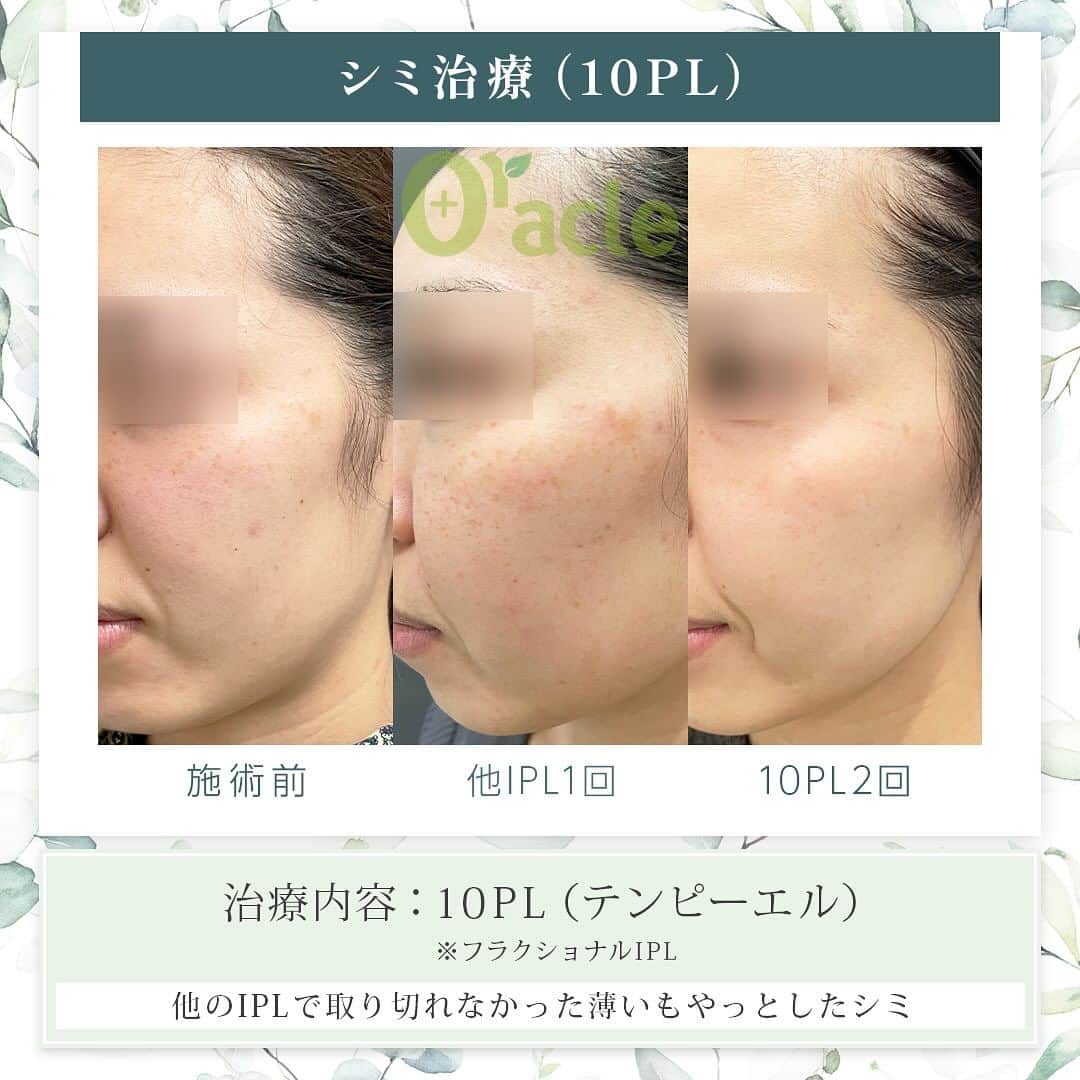 オラクル美容皮膚科東京新宿院さんのインスタグラム写真 - (オラクル美容皮膚科東京新宿院Instagram)「◤薄いシミの治療◢| 《治療内容》10PL 2回 他のIPLで治療後取りきれなかった薄いもやっとしたシミに対して、2回の治療を行いました。 10PLは全体に照射するため、シミ部分だけではなく全体がトーンアップし艶も出ております。  ☑️10PL 韓国Oracle統括院長　ノ・ヨンウ医師開発 世界初の技術『フラクショナルIPL』搭載 ➡︎特許取得  安全性 ・韓国MFDS承認機器 ・アメリカFDA承認機器  治療目的：シミそばかすの除去、肌の再生  【ダウンタイム】 赤み：3〜5日 瘡蓋：7〜10日　※テープ保護不要 洗顔：当日 メイク：当日から可能ですが、ひりつきが出ますので翌日から推奨 ⁡ 【料金】 1回38,500円税込（鎮静管理込み）  ※目周りを除く  🉐初回セット 初回セット35,000円税込（鎮静管理込み） オプション：目周り8,800円 ⁡ #シミ　#薄いシミ  #シミ取り　#シミ治療 #シミ取りレーザー #そばかす #10pl #フラクショナルレーザー #IPL #IPLレーザー #美肌　#美白 #美容皮膚科 #韓国美容　#韓国好きな人と繋がりたい #韓国クリニック #オラクル美容皮膚科」11月29日 17時24分 - oraclejp
