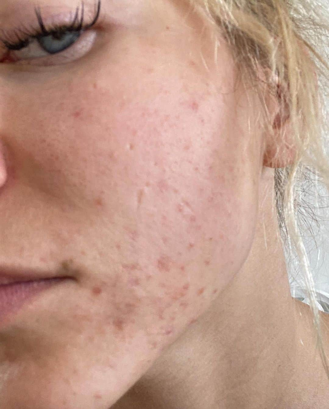 アギーさんのインスタグラム写真 - (アギーInstagram)「This is just a reminder that you are not your skin, your weight and your swollen face. But your acne is happening TO you, it’s happening FOR YOU.  Underneath all of these signs is a healthy body managing a sick environment. There is a soul that is here to do bigger things than worrying about her acne every day.  As someone who had acne, I know it’s hard to think about grand ideas and things when all you can think about is being healthy is your default and your birthright.  I’m on a mission to save women the time and the guest work. It takes time to figure out why the acne is happening FOR them, but it doesn’t have to take your years.  If it wasn’t for my acne, I would ignore the fatigue, the toxic relationship, and the burnout I felt from having almost a million people following me for a woman who I was no longer resonating with.  I didn’t want to disappoint my 900k followers, but I was deeply disappointing myself.  Remember: these are not symptoms, these are invitations to look within and listen to your body.  I’m here to cheer you on and remind you of your greatness.  You’re here to do big things Mama. Don’t major in minor things.  Major in yourself and your body.  Love, Aggie   #transformation #diet #biohacking #biohackingsecrets #BiohackLikeaWoman」11月30日 9時35分 - aggie