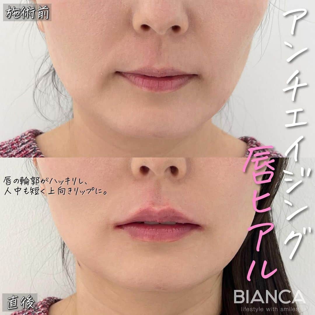 辻沢由有（BIANCA CLNIC 表参道院 院長）さんのインスタグラム写真 - (辻沢由有（BIANCA CLNIC 表参道院 院長）Instagram)「#dryuuヒアル  唇ヒアルロン酸はアンチエイジング効果も抜群❤️ 治療時間、約10分👏 ヒアルロン酸でここまで変えられます✨  どうなりたいかわからない方も こだわりがたくさんある方も 綺麗になりたい方、お任せください🥰  ✽.｡.:*・ﾟ ✽.｡.:*・ﾟ ✽.｡.:*・ﾟ ✽.｡.:*・ﾟ ✽.｡.:*・ﾟ  ✔︎唇ヒアルロン酸 Juvederm VOLBELLA 1ml  77,000円＋税 別途施術料　22,000円＋税  ⏳治療時間: 10分 🗓持続期間: 1〜2年 😷腫れ・内出血: 数日程度 ⚠️リスク: 感染・血流障害・凹凸など  ✽.｡.:*・ﾟ ✽.｡.:*・ﾟ ✽.｡.:*・ﾟ ✽.｡.:*・ﾟ ✽.｡.:*・ﾟ  📝ご予約はwebが便利です✨ プロフィール欄のリンクからご予約ください。 ※医師指名可能（“大久保医師指名”をクリック） ※診察料はかかりません🙅‍♀️ ※表参道院勤務が9割となっています。  📍BIANCA CLINIC ※お電話頂くと自動音声通話に繋がります。 ✔︎表参道院 ☎️05018071593 東京都港区南青山5-11-10  南青山511ビル 2F ✔︎銀座院 ☎️05031964834 東京都中央区銀座1-8-19 キラリトギンザ12F  •診療時間 10:00〜19:00 •年中無休（年末年始を除く）   ✽.｡.:*・ﾟ ✽.｡.:*・ﾟ ✽.｡.:*・ﾟ ✽.｡.:*・ﾟ ✽.｡.:*・ﾟ  #唇ヒアルロン酸  #eライン #横顔美人 #リップヒアルロン酸#ヒアルロン酸」12月2日 15時57分 - i_am_yuu__